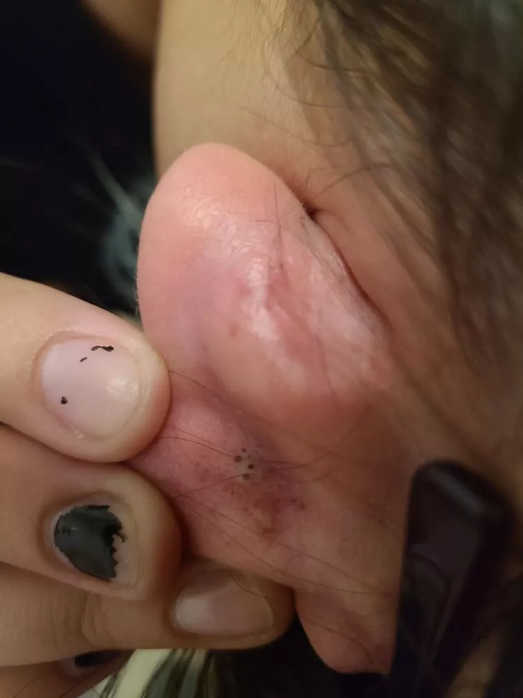 I found these blackheads behind my ear