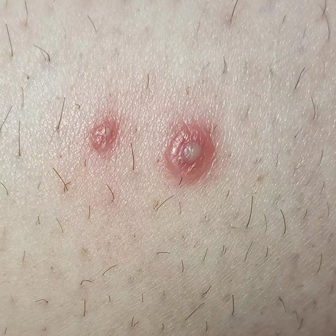 my forbidden heat rash pop