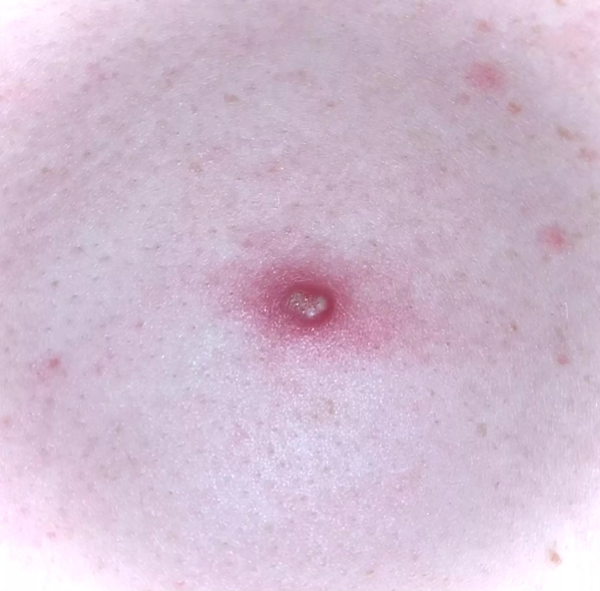 Possible pimple on my partners back. Looks too angry to pop