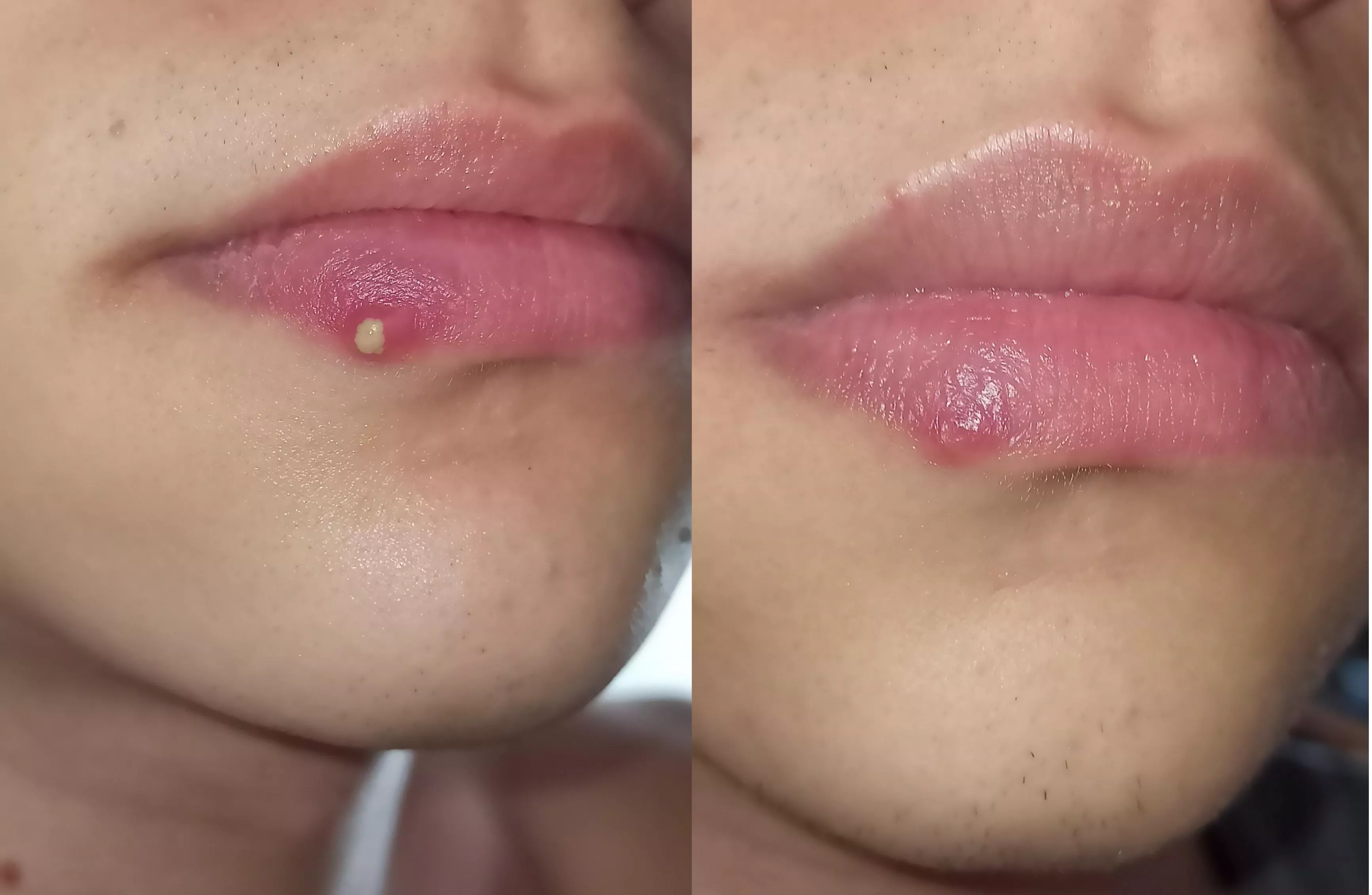 before and after the worst pimple I had