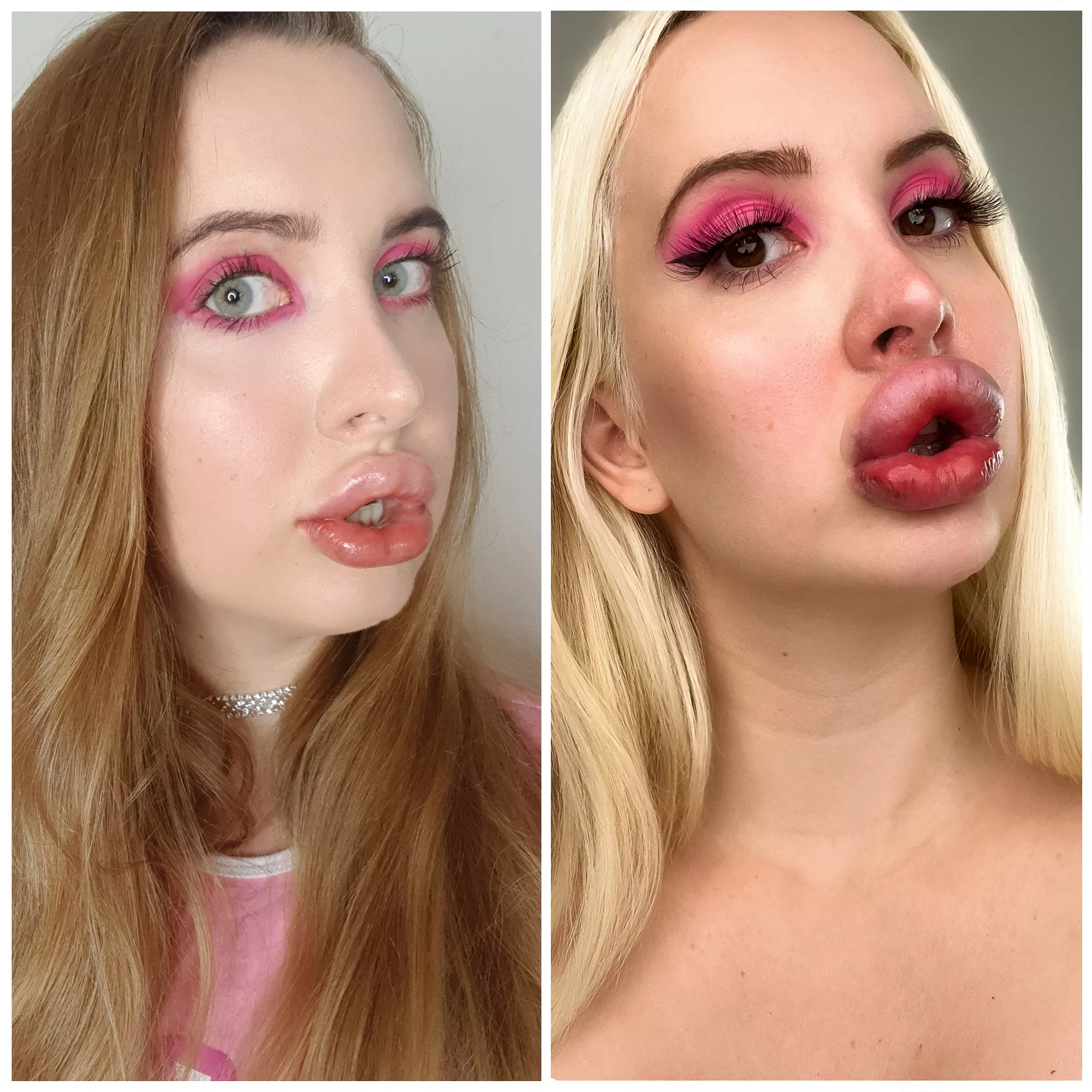 My lip expansion so far :)