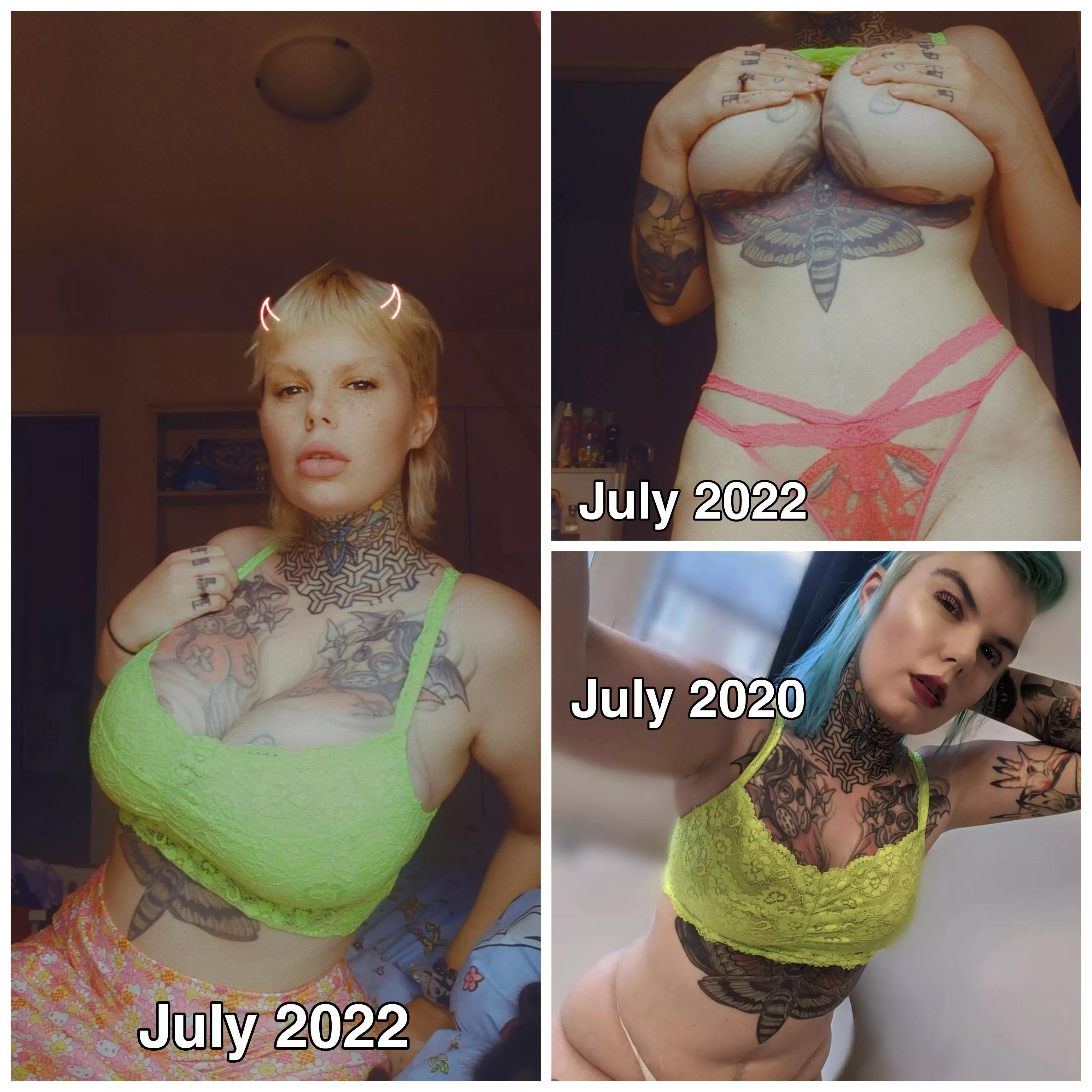 July 2020-22 Lip filler, 1,100cc implants and a bbl with a tummy tuck