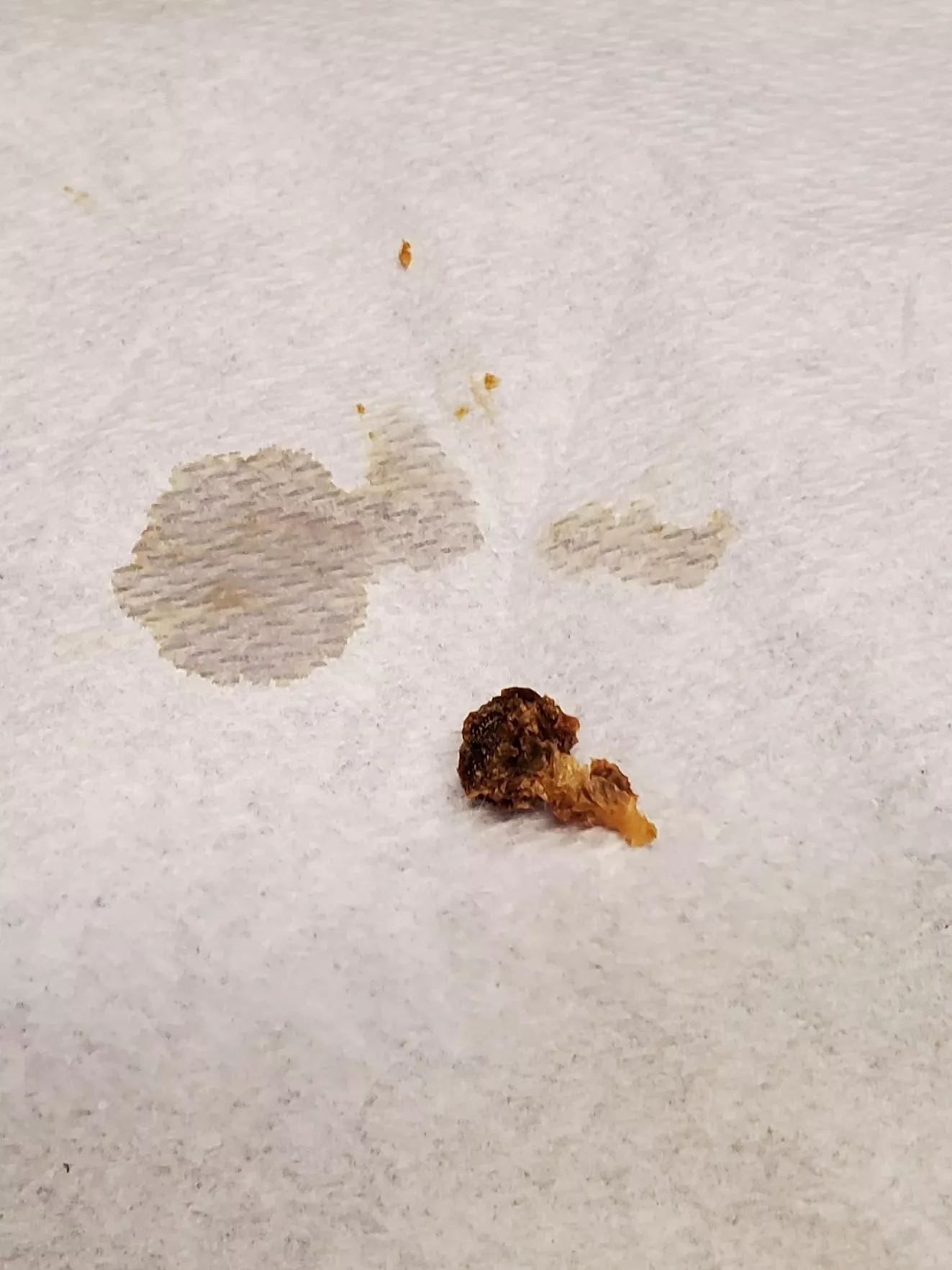 OC ear flushing results