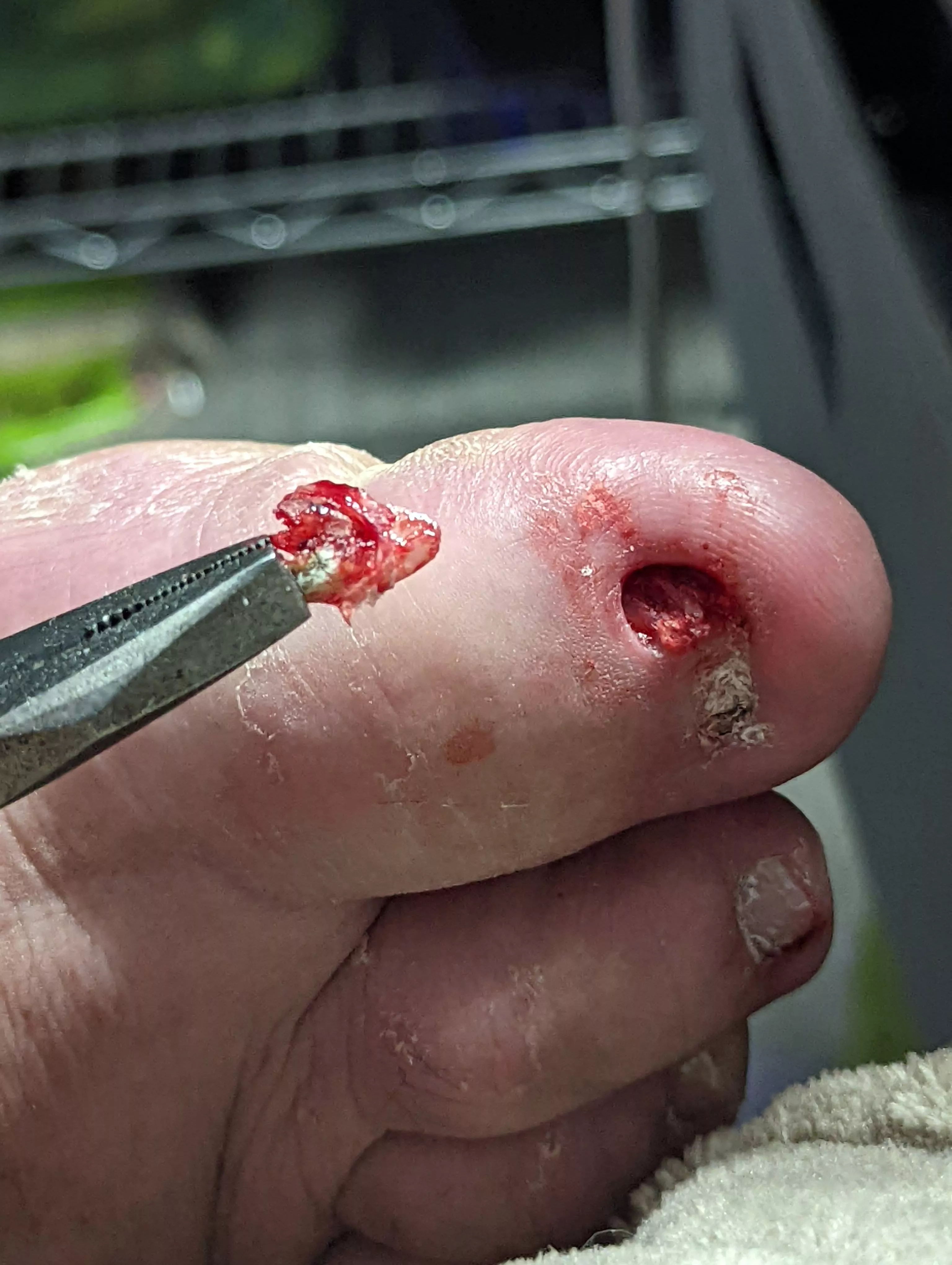 Toenail Shard from 'dead' nail bed