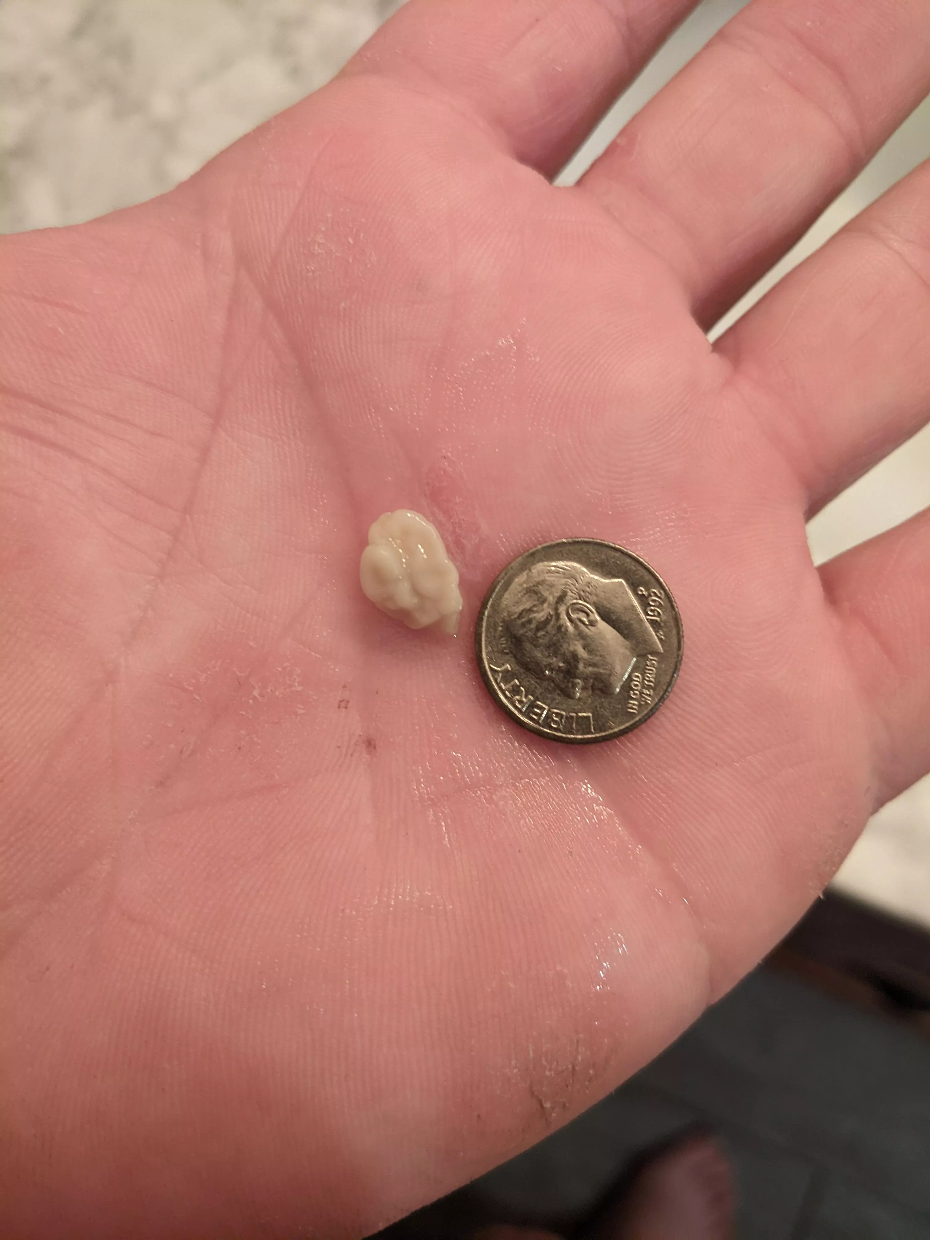 tonsil stone I got out today