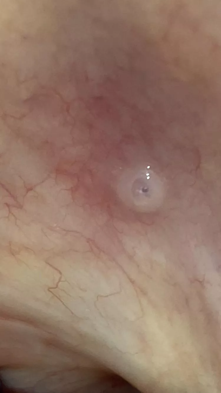 Hello,sorry for pic im just freakin out. This is on my palate,its not painful or something,can u tell me what is it?