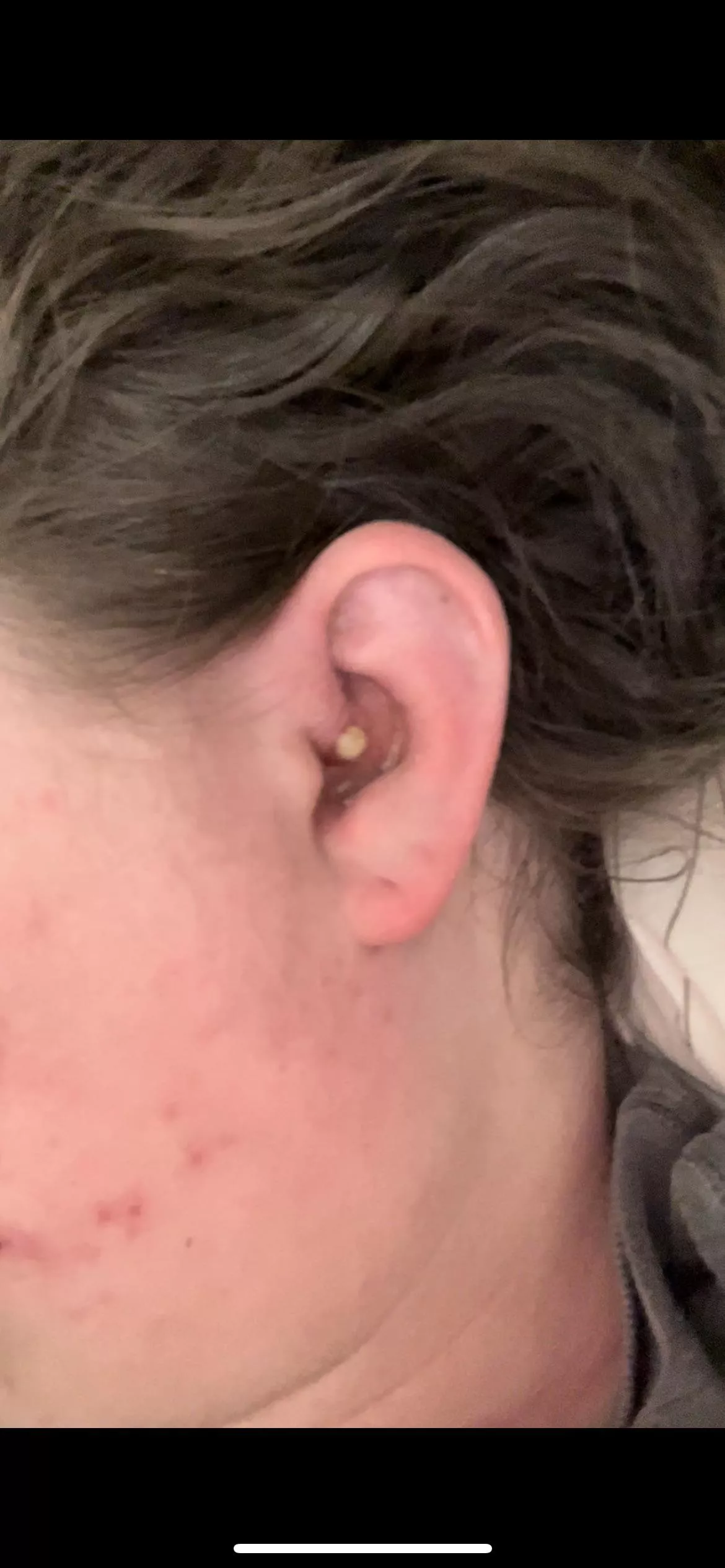 Most painful ear cyst