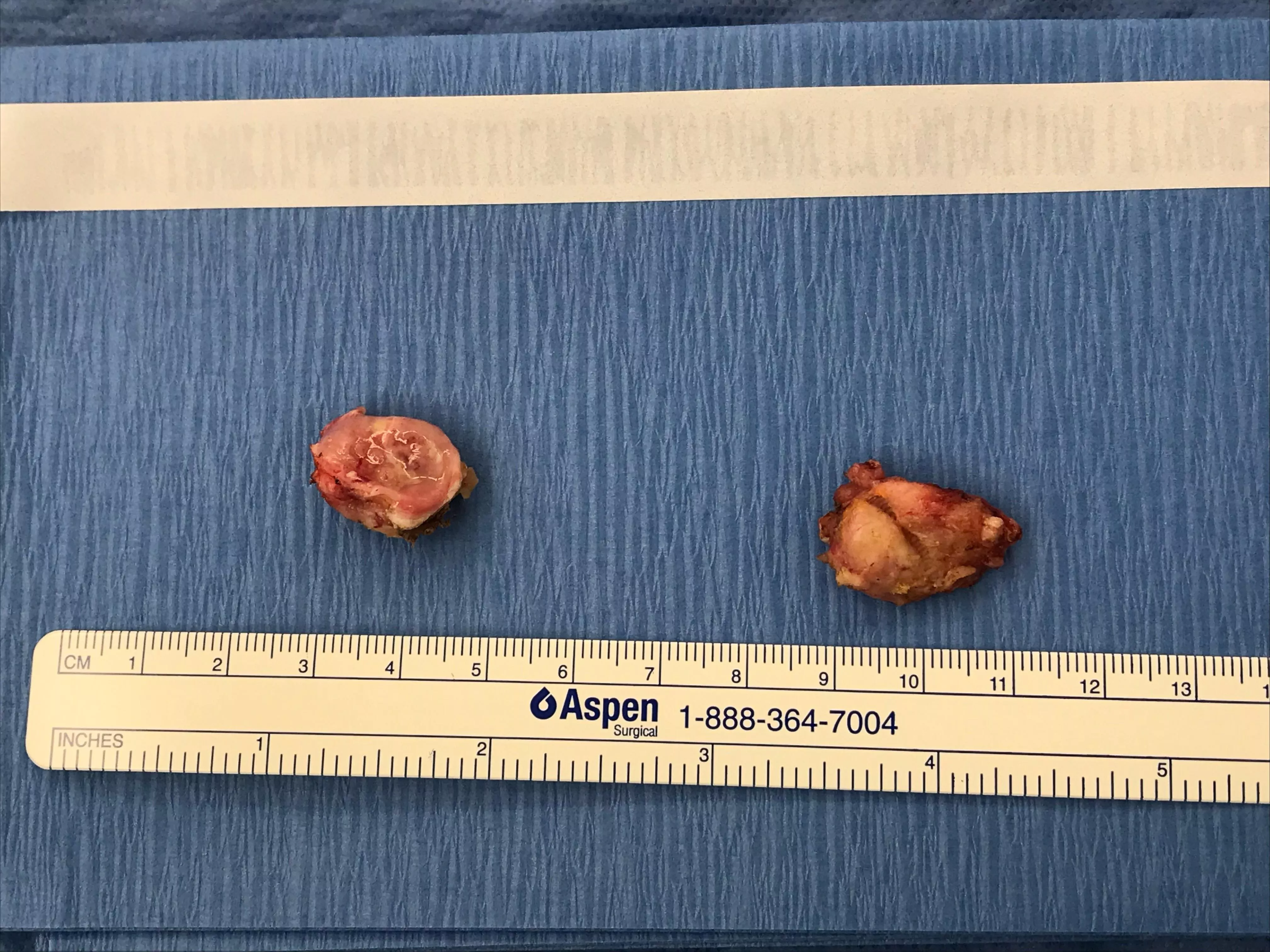 Tonsil Removal - Dr said the left one came with some stones. I was never able to pop them. But the right one was clean cause I could pop it.