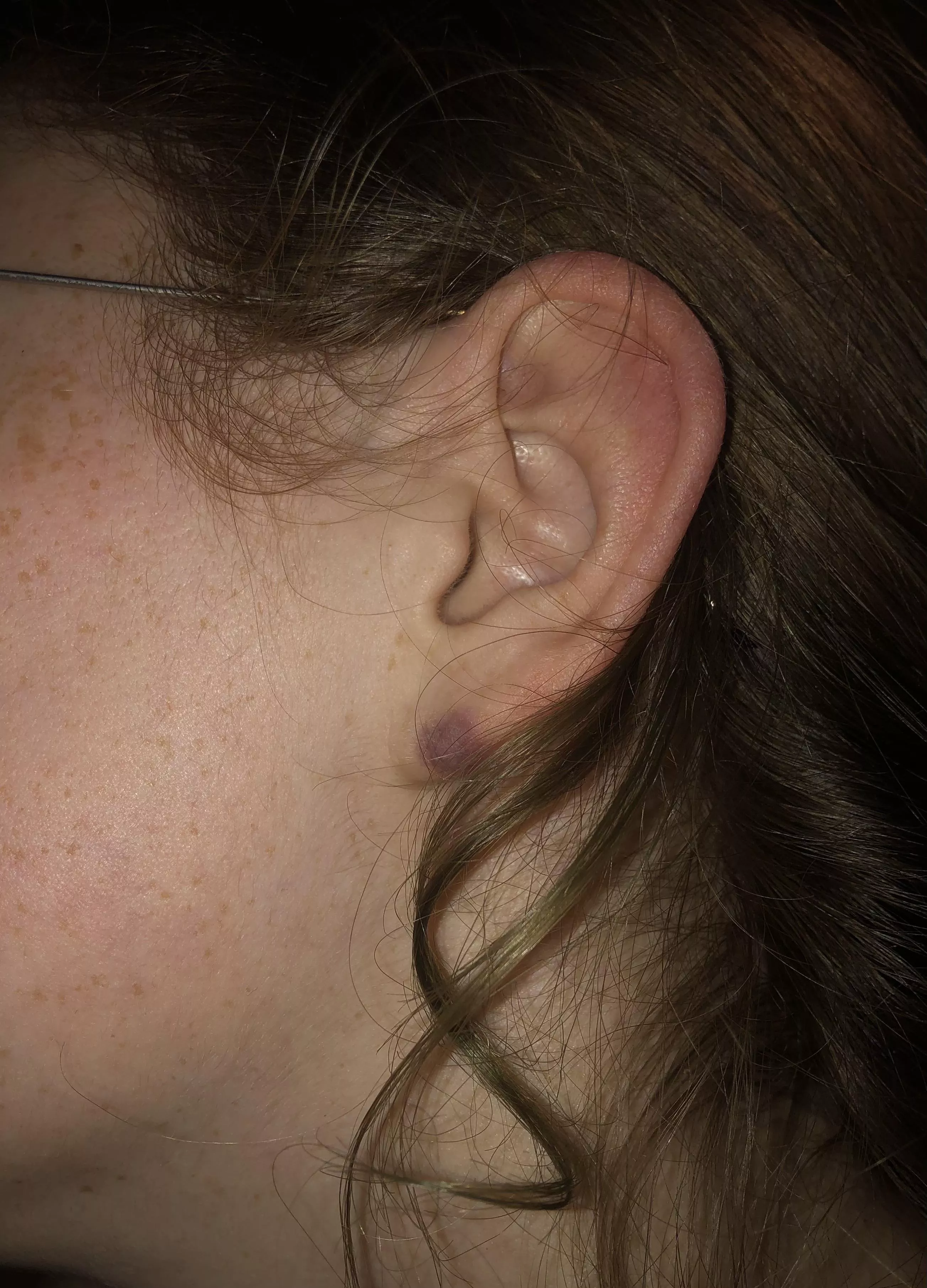 What is this bruise like thing on my girlfriendâ€™s left ear lobe?