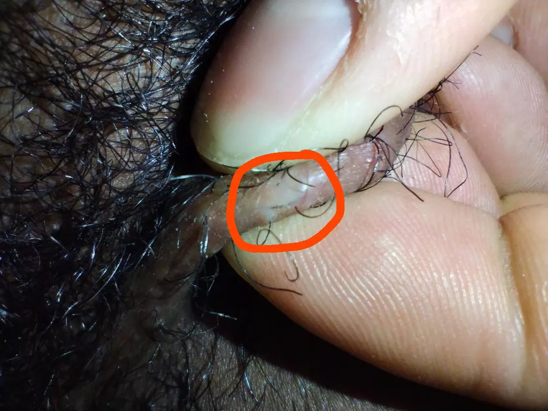 A little ingrown hair grrrrr