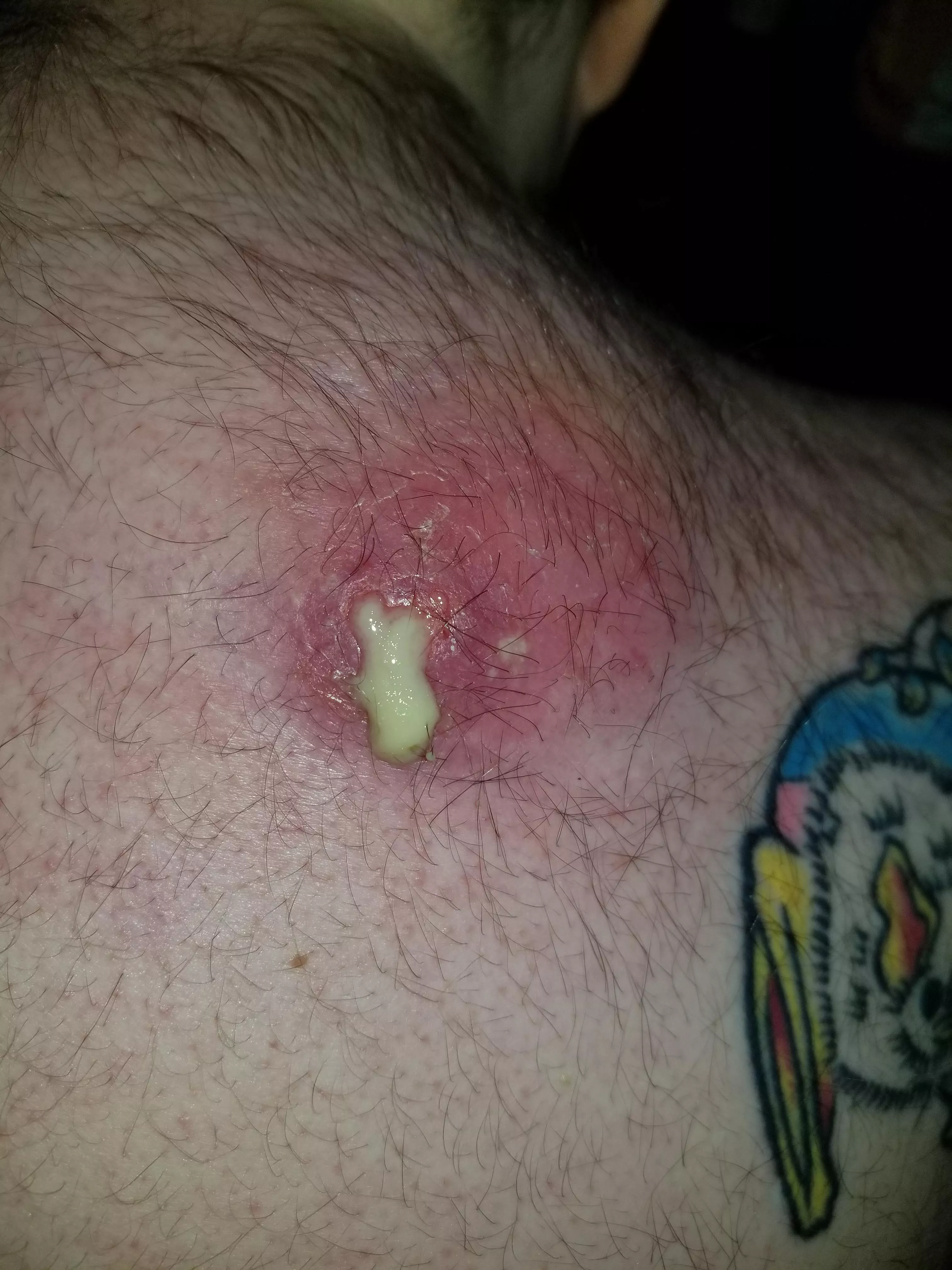 Infected Abscess Popping on it's own