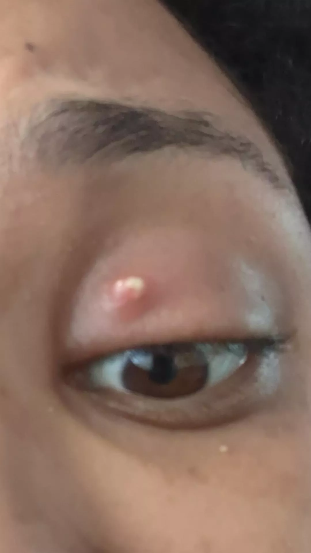 infected oil gland on my eyelid.