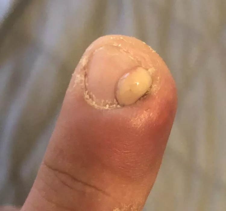 I really need to stop picking my nails. This hurt, sorry I couldnâ€™t get video.