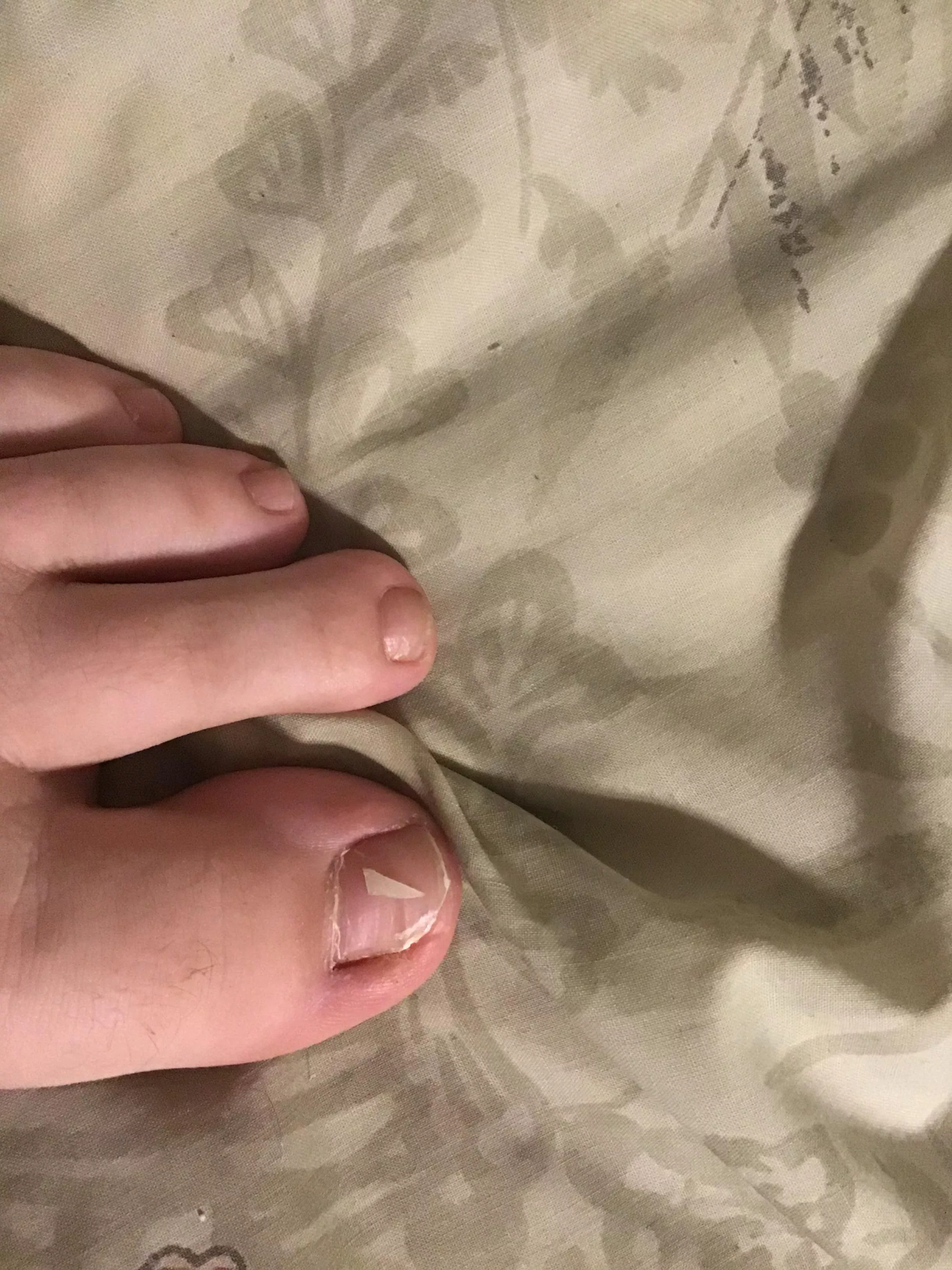 My foot started bothering me, turns out I had the beginnings of an ingrown toenail. 10 minutes and using a nail clipper, files and a toothpick this is the result. Completely bloodless removal!