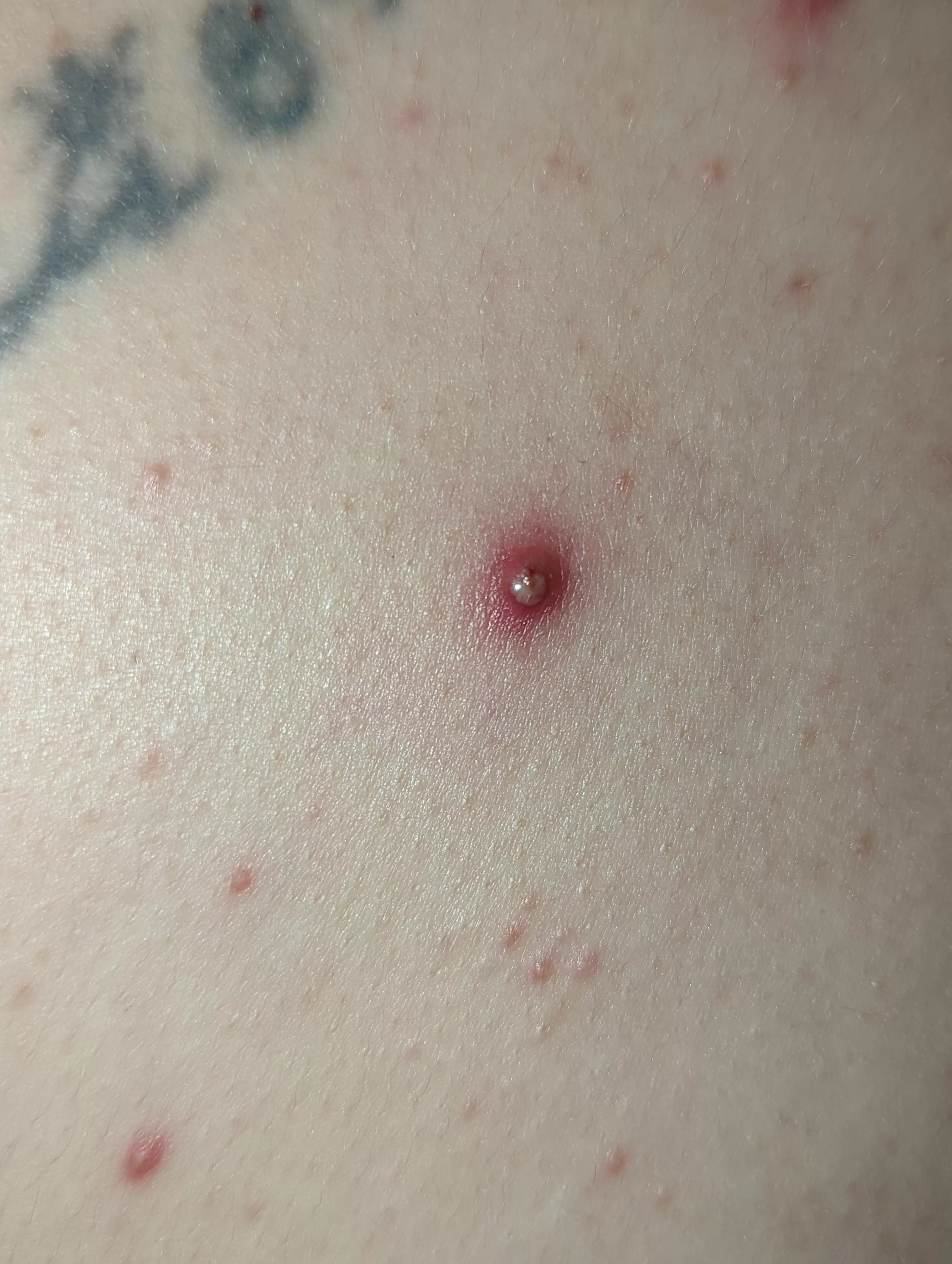 My partners back pimple