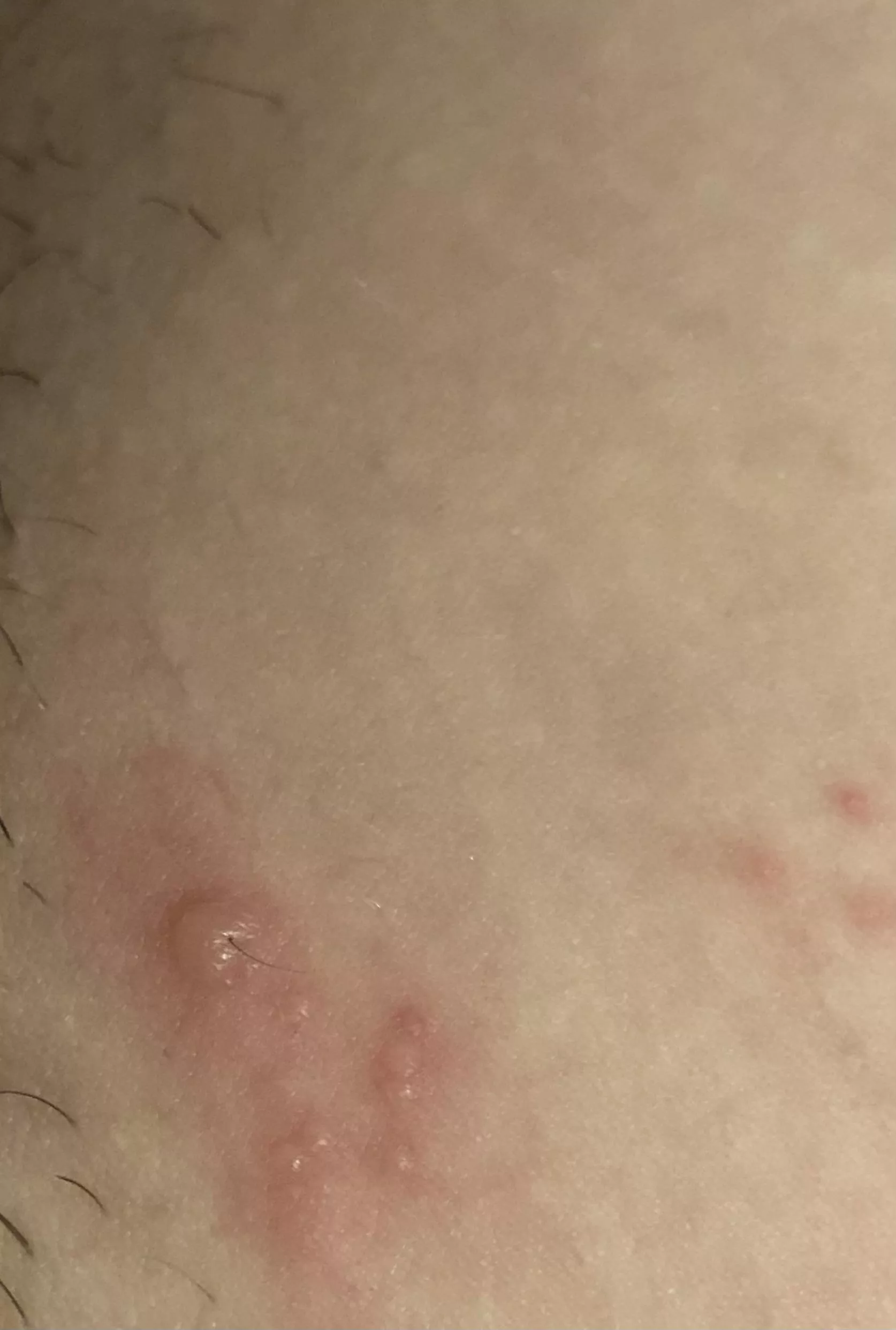 Can anyone tell me what this may be ? Iâ€™m freaking out . Itâ€™s near my bikini line . Literally just popped up