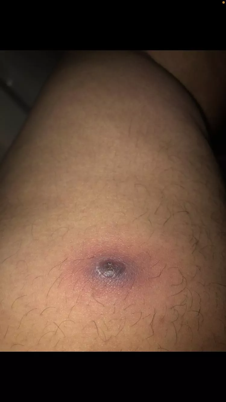 What the hell is this on my thigh?