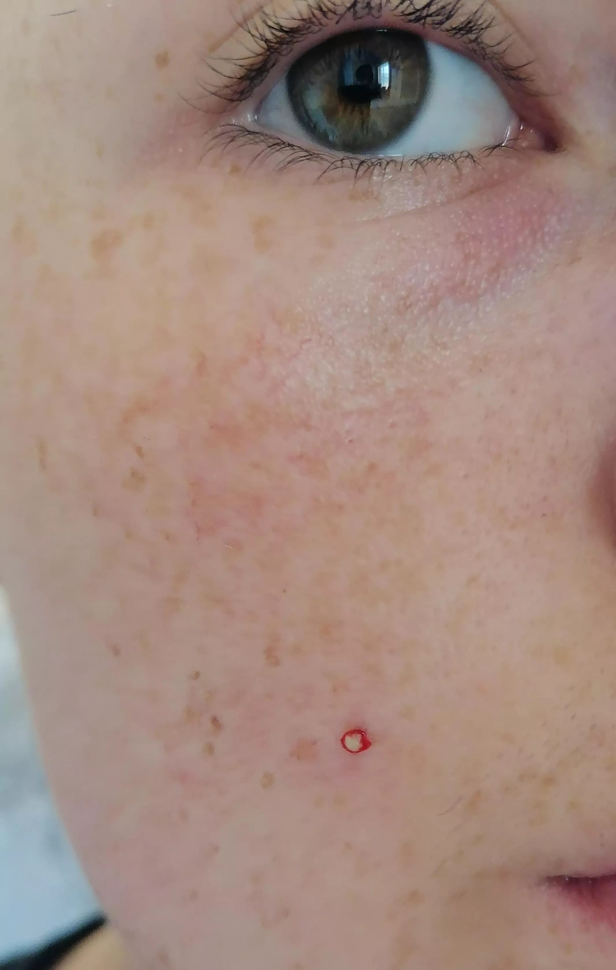 Satisfying pop on my cheek (own image)