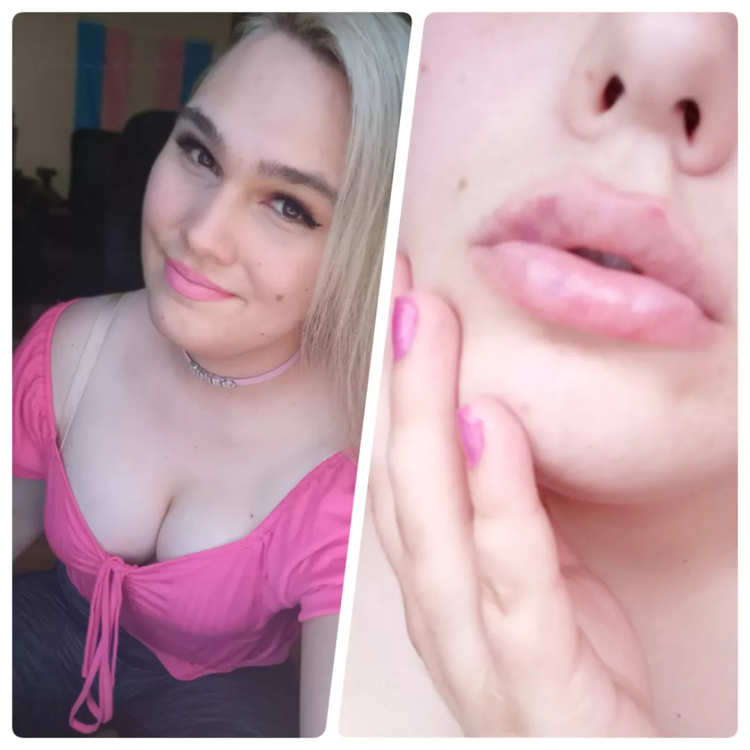 0 Syringes -> 2 Syringes! 💕 Love my bimbo lips. should I get bigger?