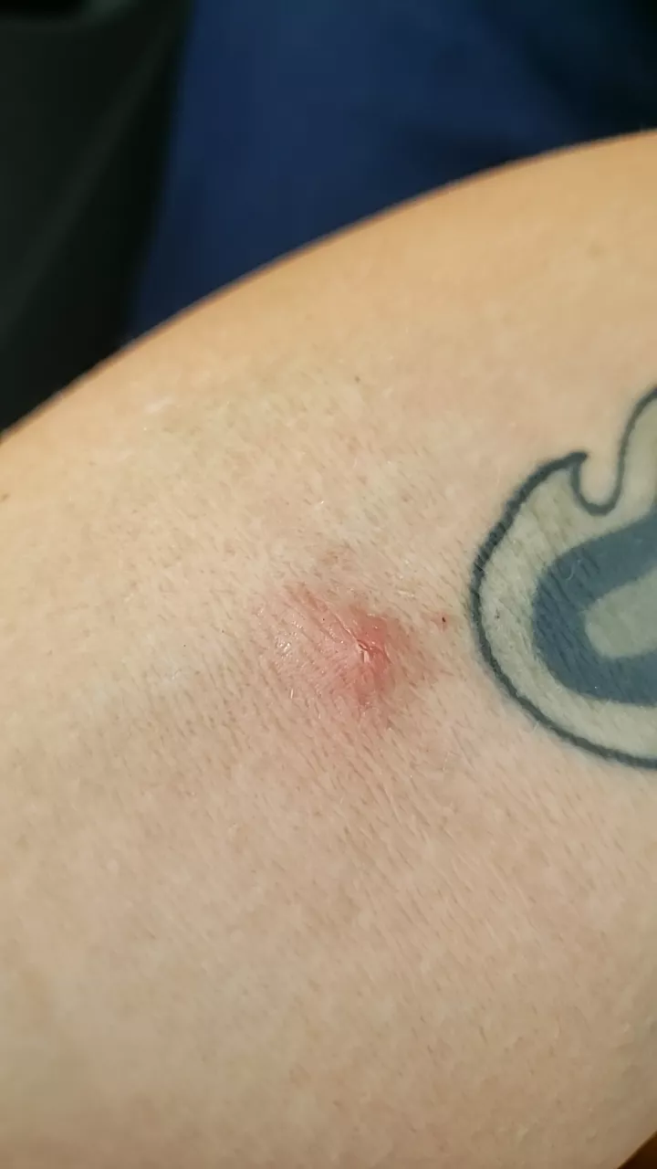 what is this?? (inner elbow crease)