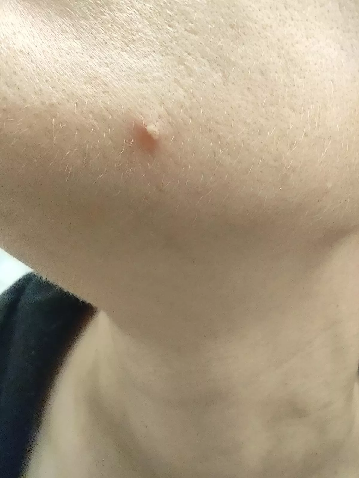 Woke up earlier with this little thing on my jaw