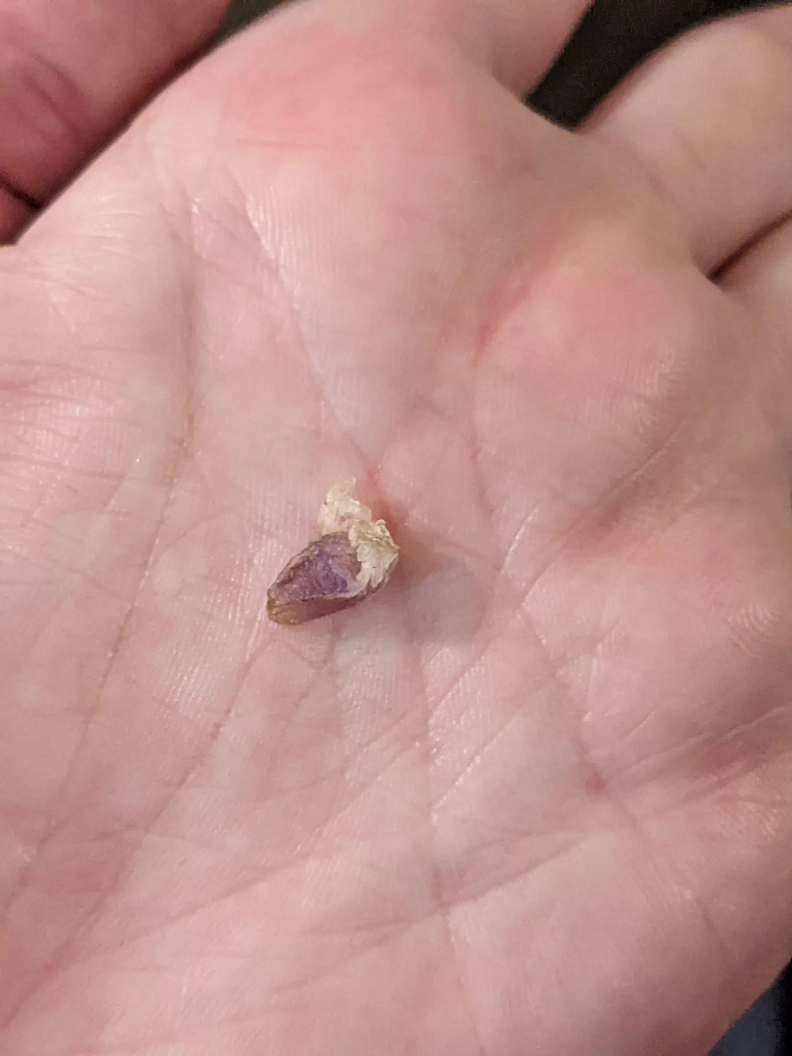 I had surgery to have my fallopian tubes removed two weeks ago. today, the chunk of puss and surgical glue fell out of my belly button.