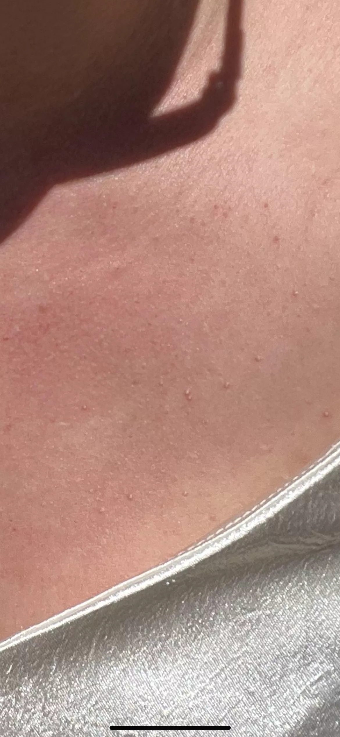 What are these white head/pustules I keep getting on my chest?