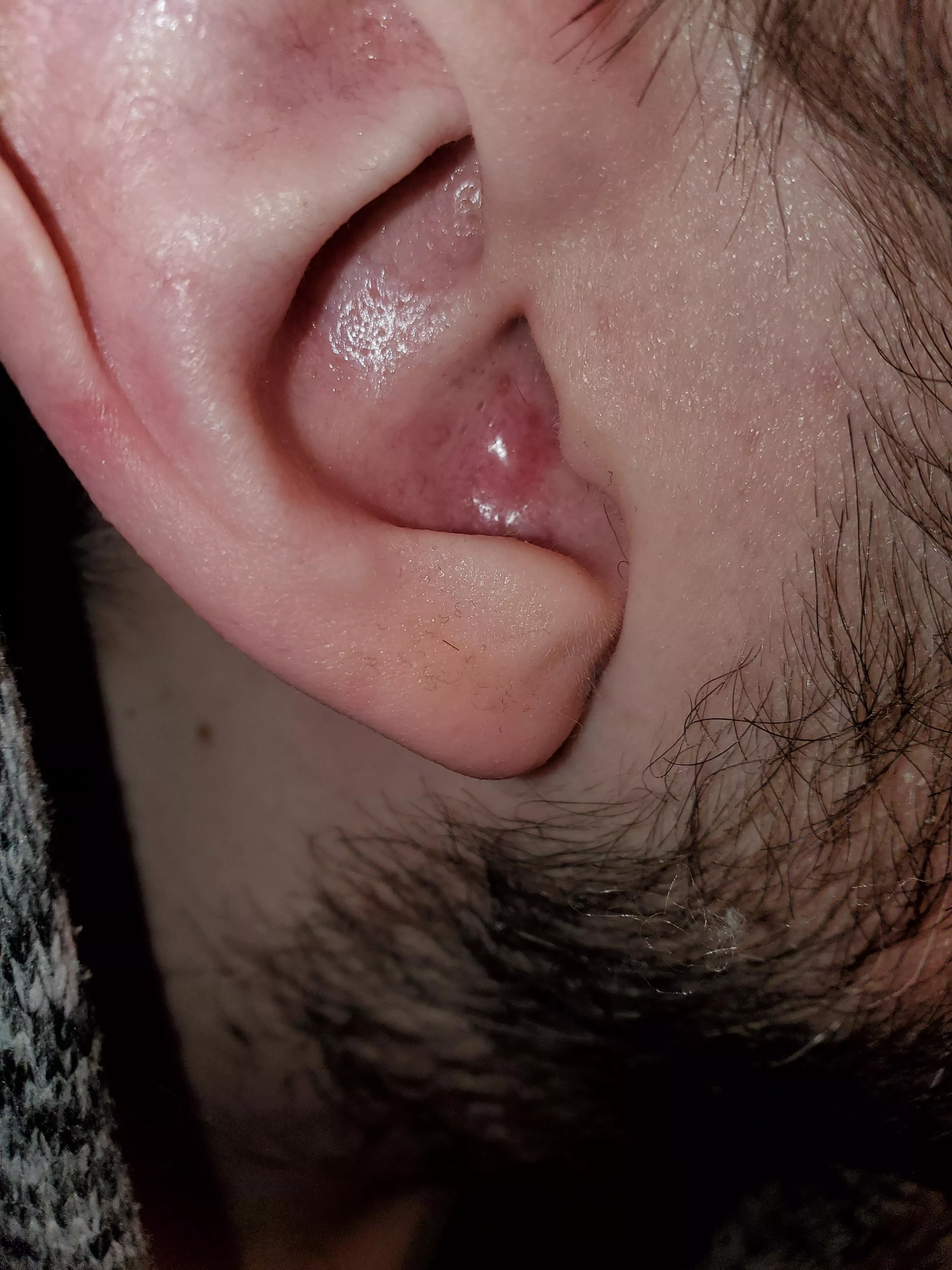 What's This Hard Lump In My Ear?