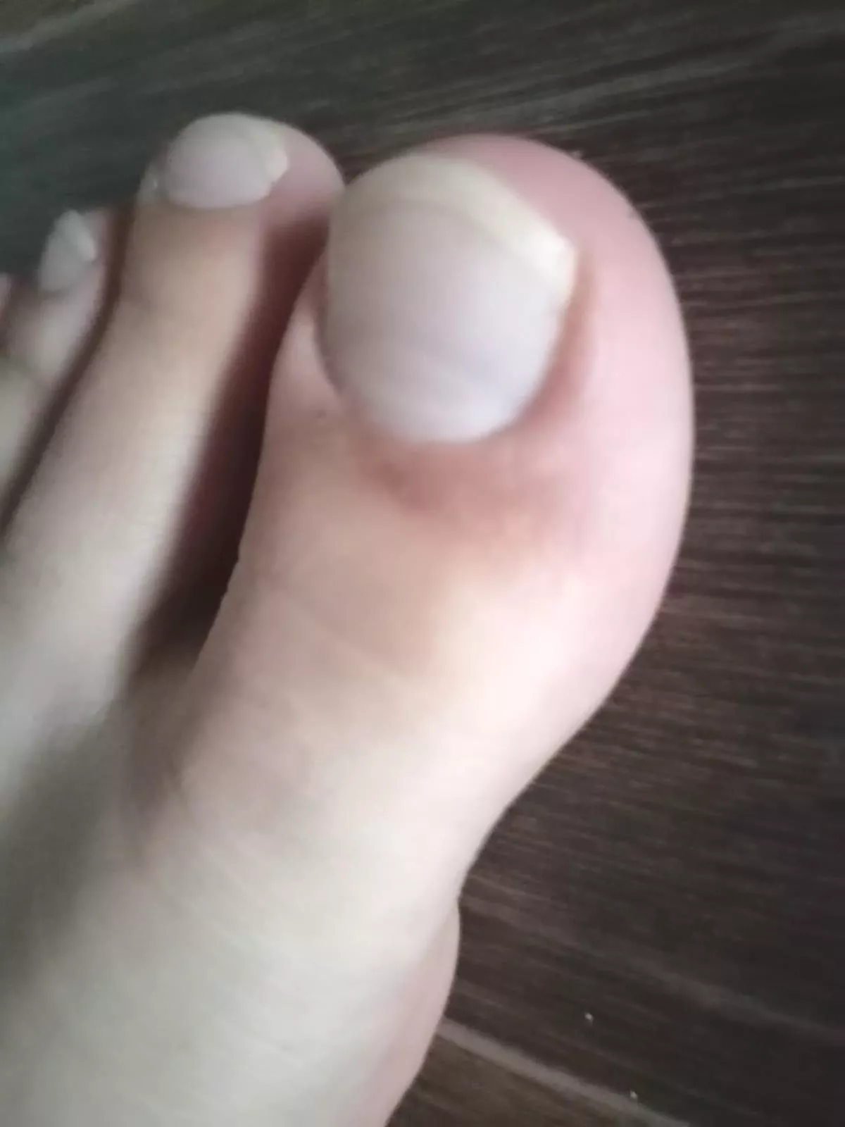 Who any have huge toenails? 🤩