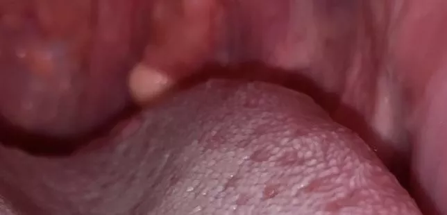 Helpâ€¦something shaped like ball in throat (pic included)