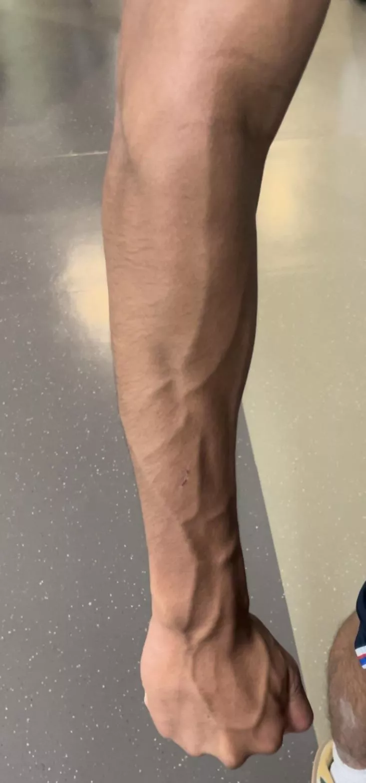 My vascular forearm canâ€™t wait for a pump