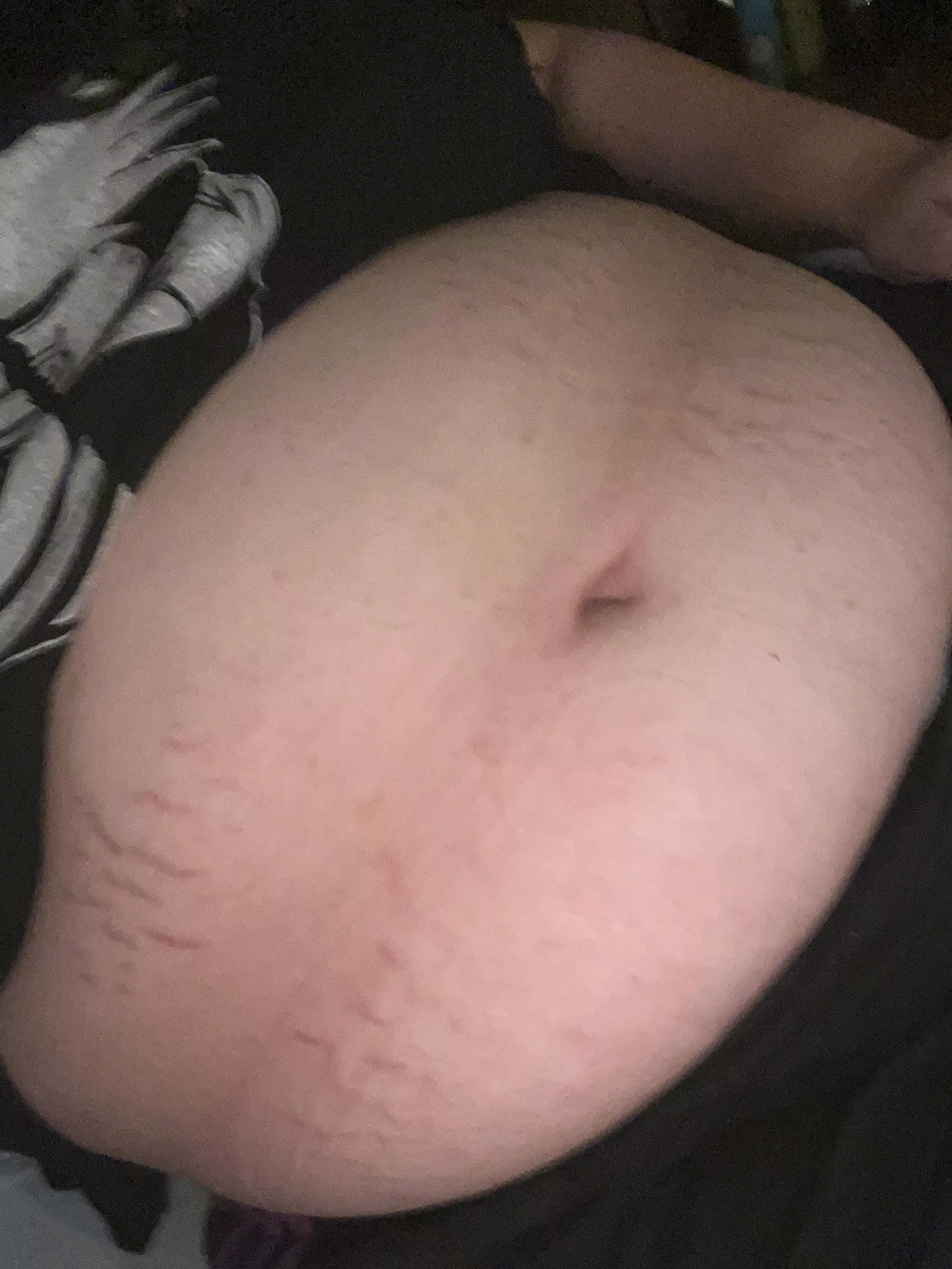 I’m really getting a lot of stretch marks. Tease me for getting fat!