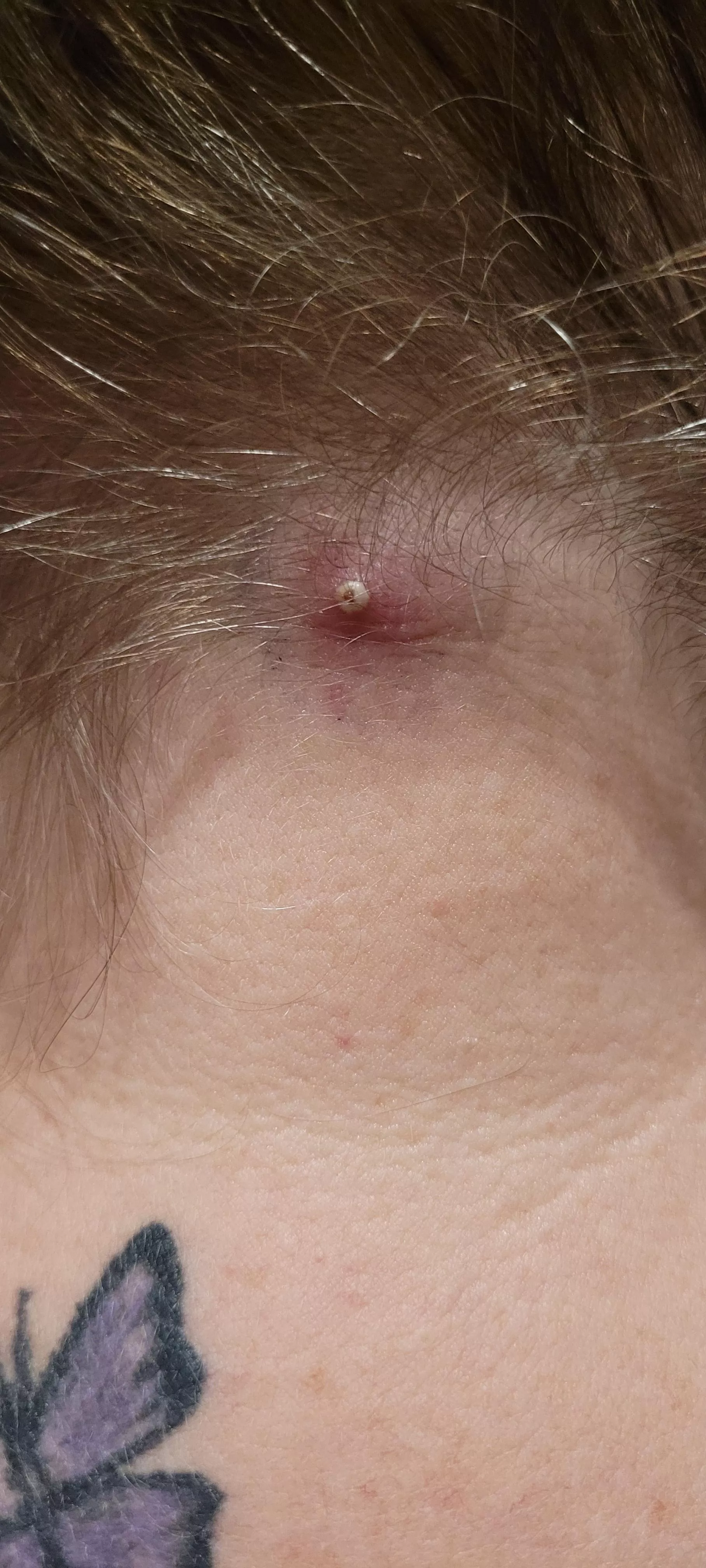 Inflamed cyst on nape of neck. (OC)