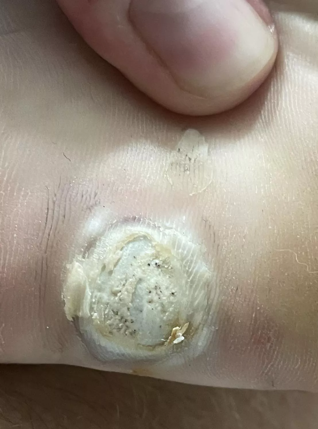 Plantar wart in treatment.