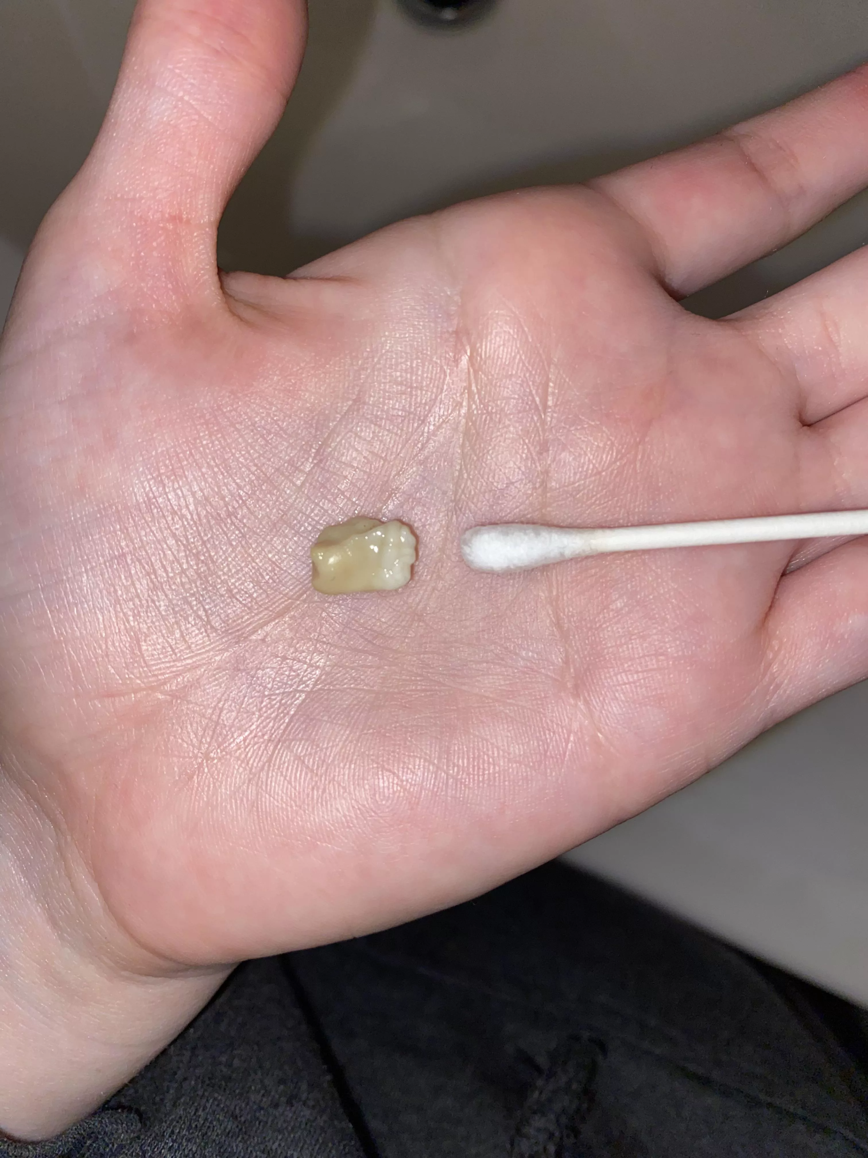 Freshly harvested tonsil stone— my biggest yet, q-tip for scale