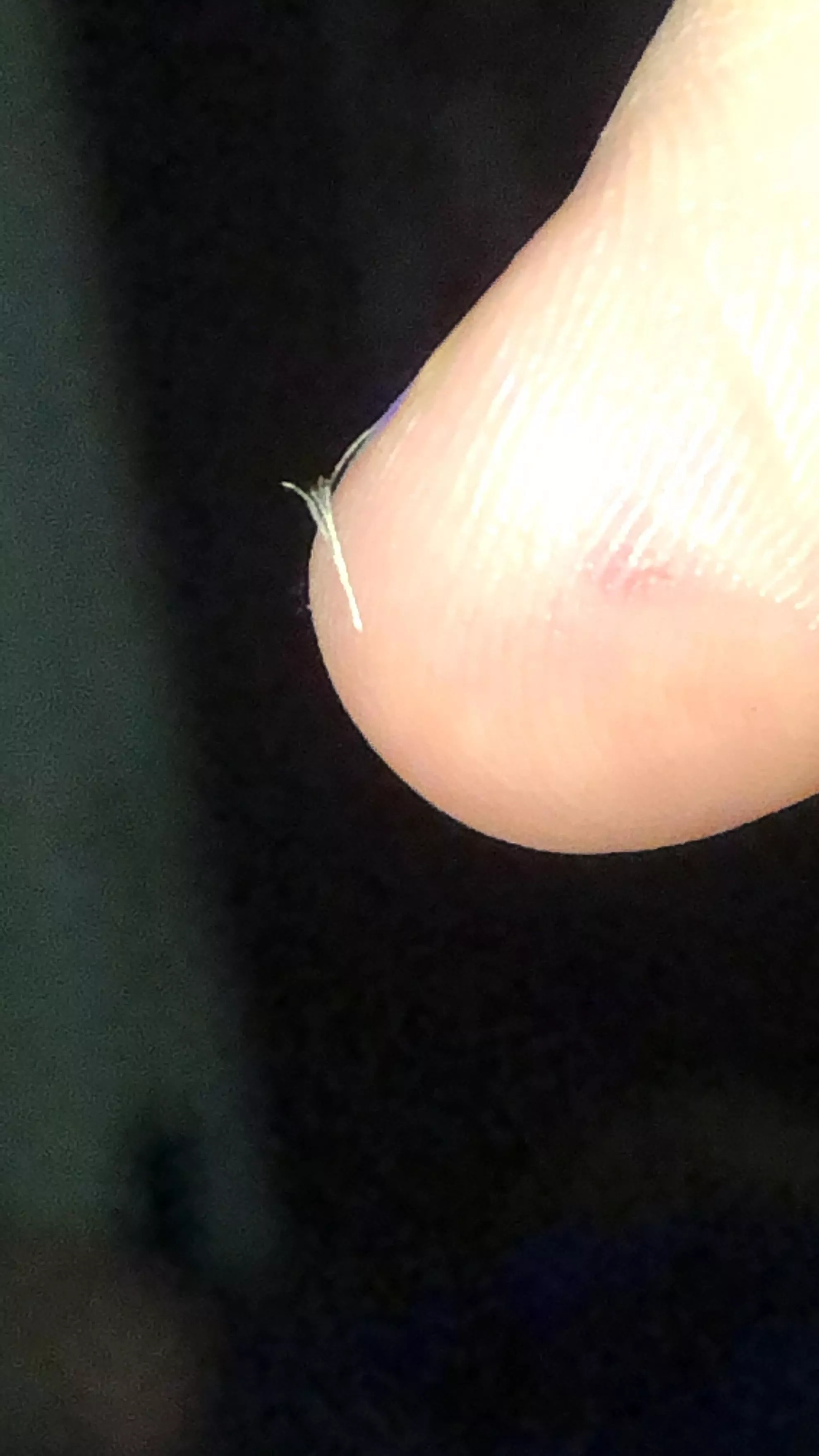 A nice pili multigemini I pulled out of a stretch mark on my side. These are so fun to pull out!