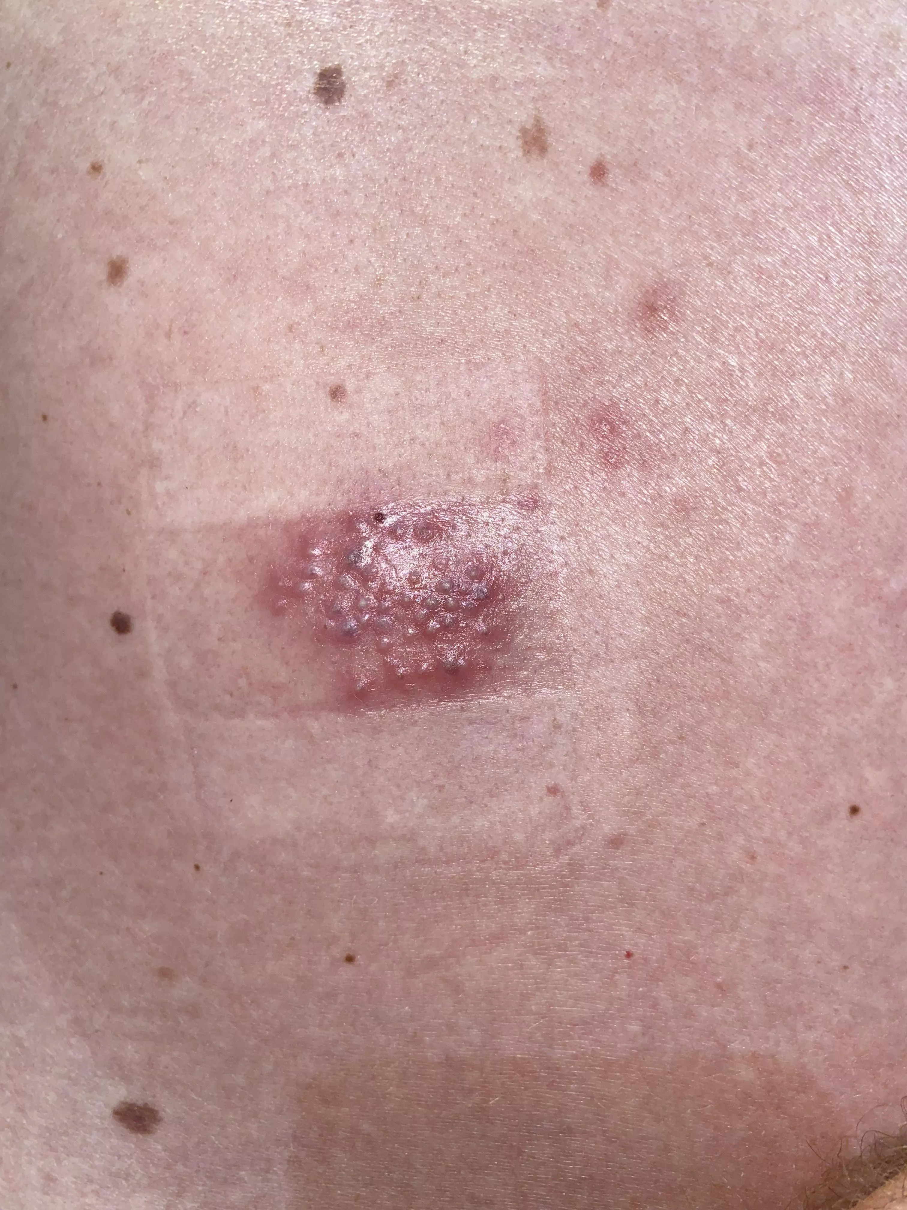 Forbidden pops on my back, Doctor says it is shingles but I have no pain, only slight stabbing pain when I do a slight back bend but none of the other pain I read about.