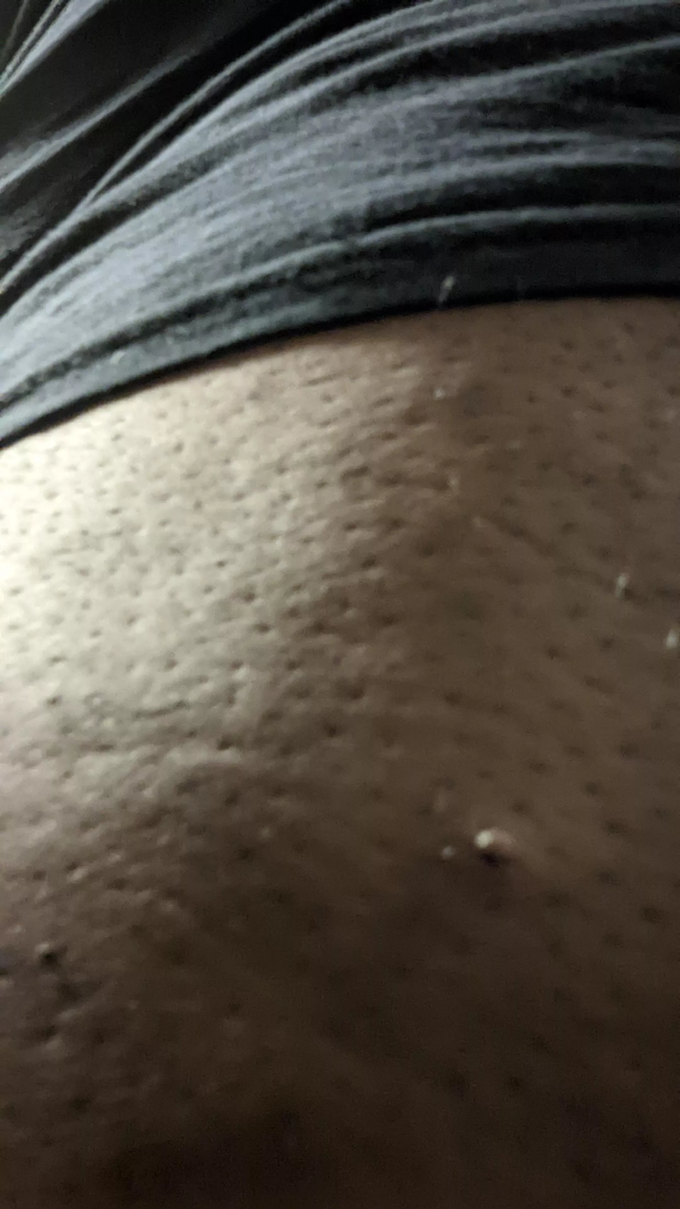 Uncomfortable bump on my back thigh