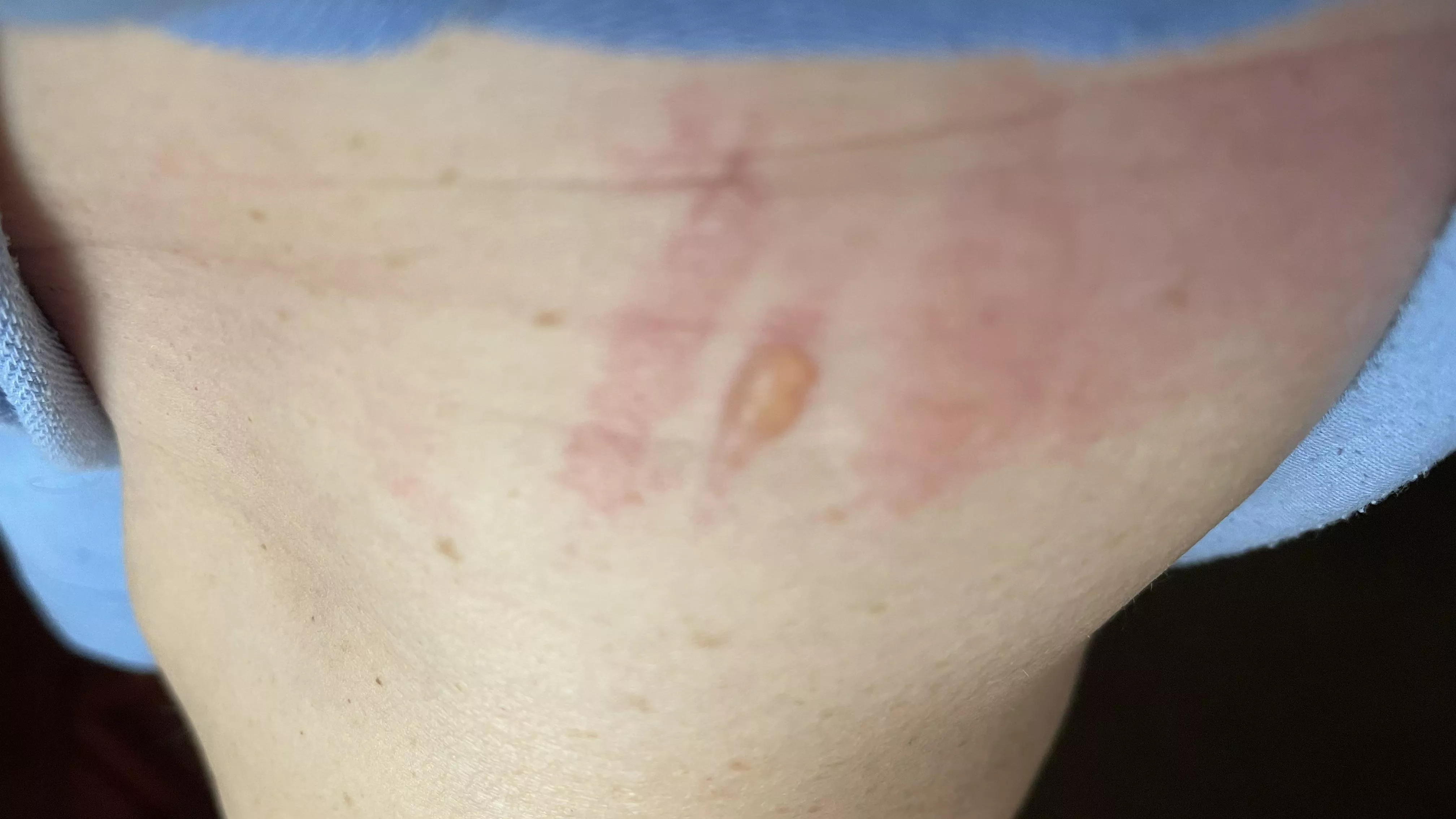 Blister from body brace.