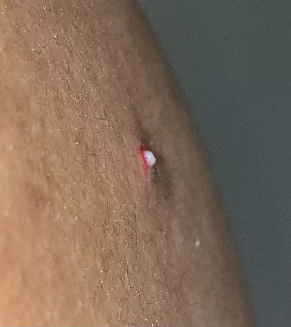 Popped this big boy on my back