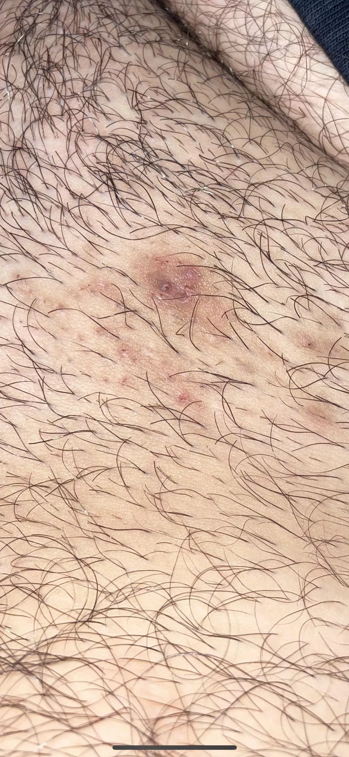 Ingrown hair in the pubic area thatâ€™s been there for a year now. Popped it before, tried picking at it multiple times. When I try to squeeze it now, nothing happens. Any ideas or recommendations?