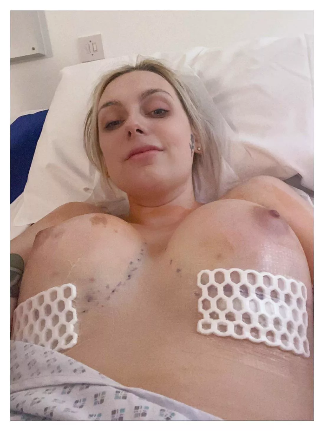 Just otu of surgrey! Still super sore and achey, but everything went well and m happy/healthy. Went from 34B to a 34E