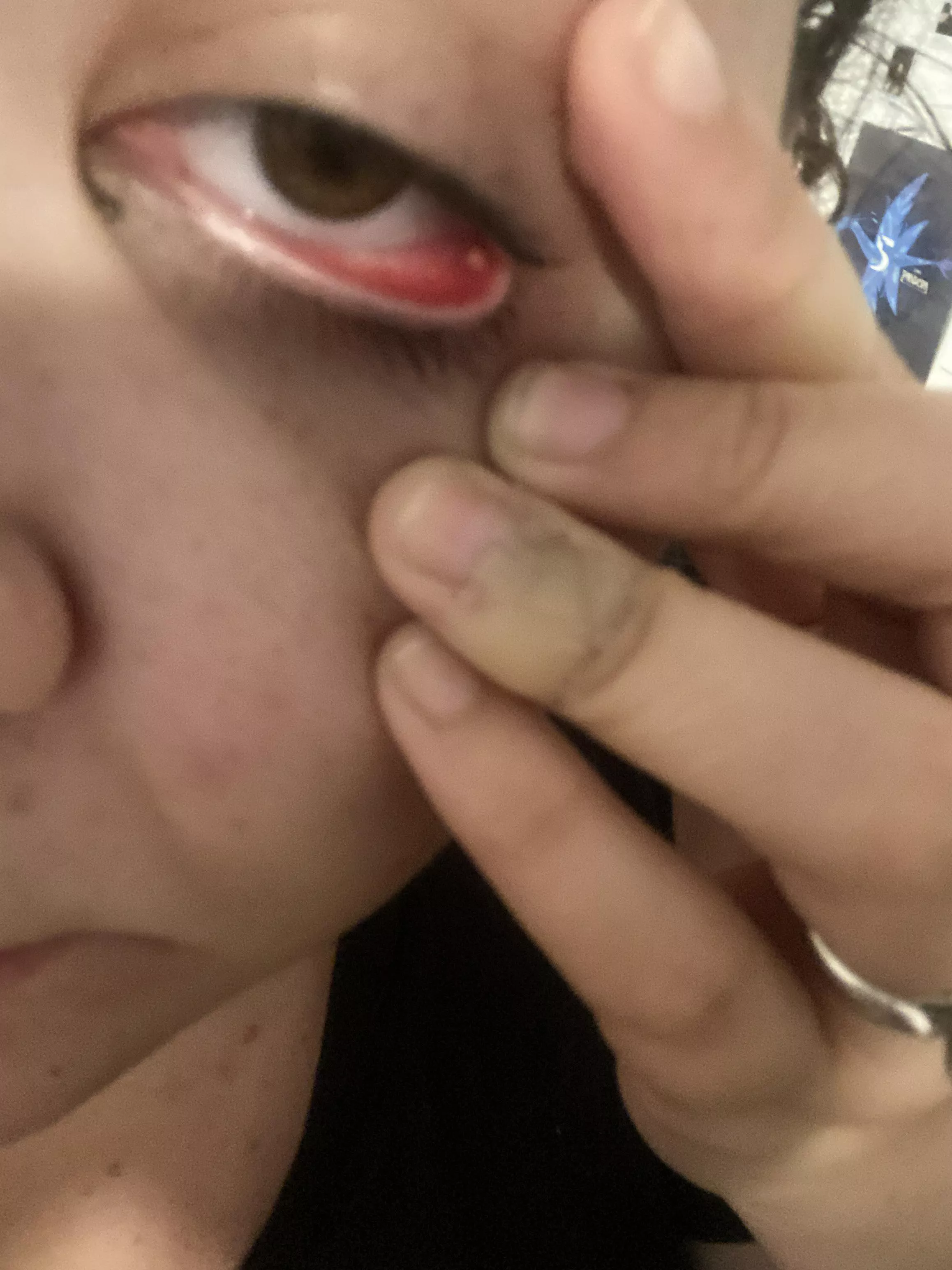 Help! What is this??? Very tender eye area