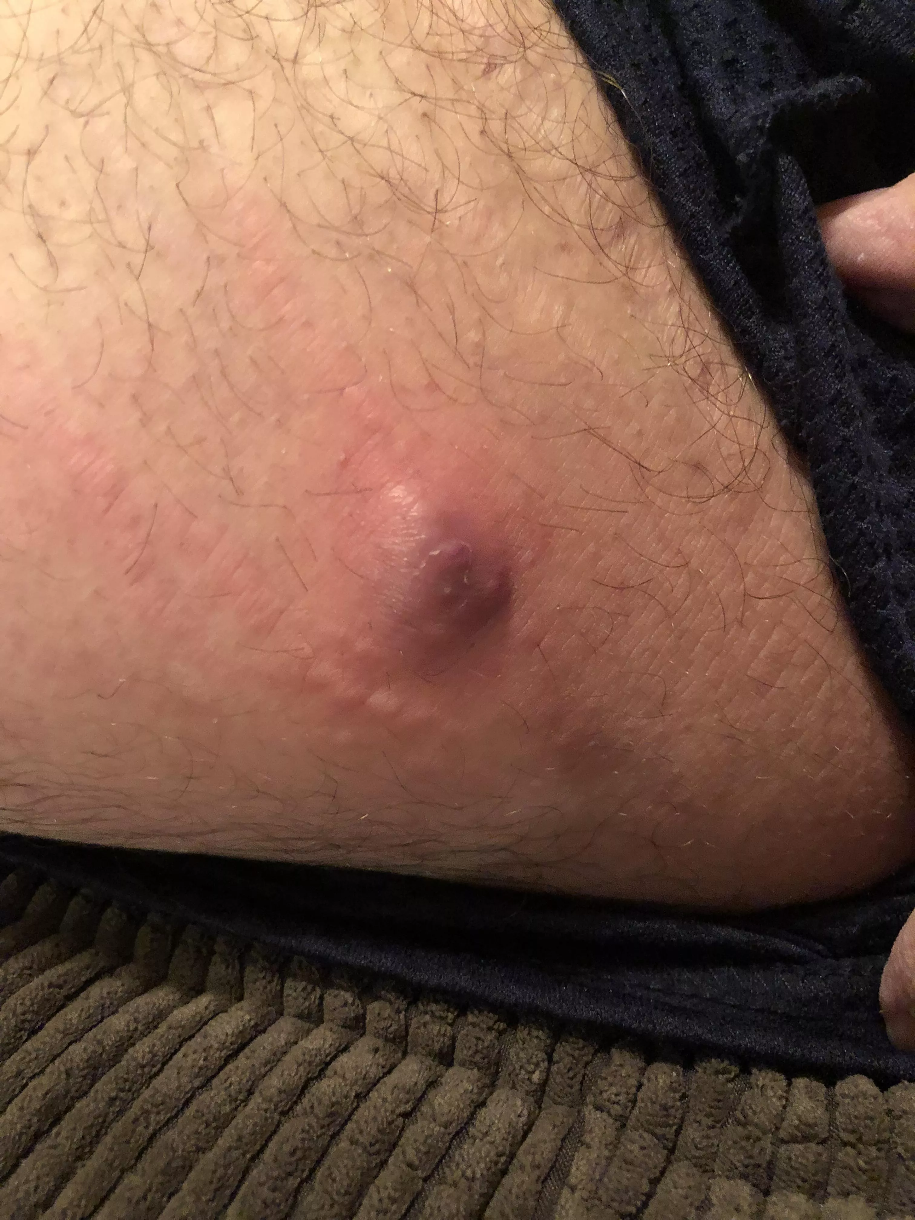 Big Giant Abcess on Leg (I Think)