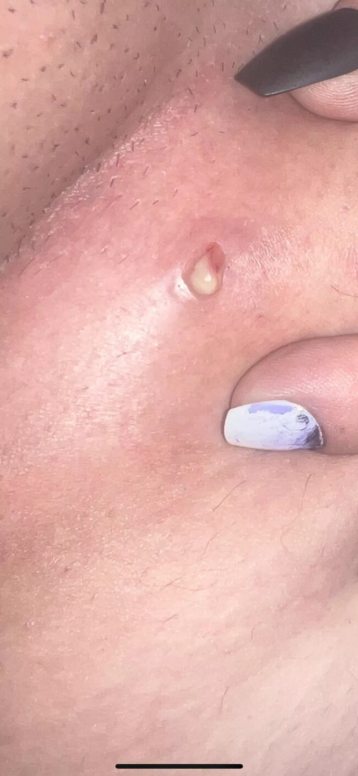 Decent pop on bikini line