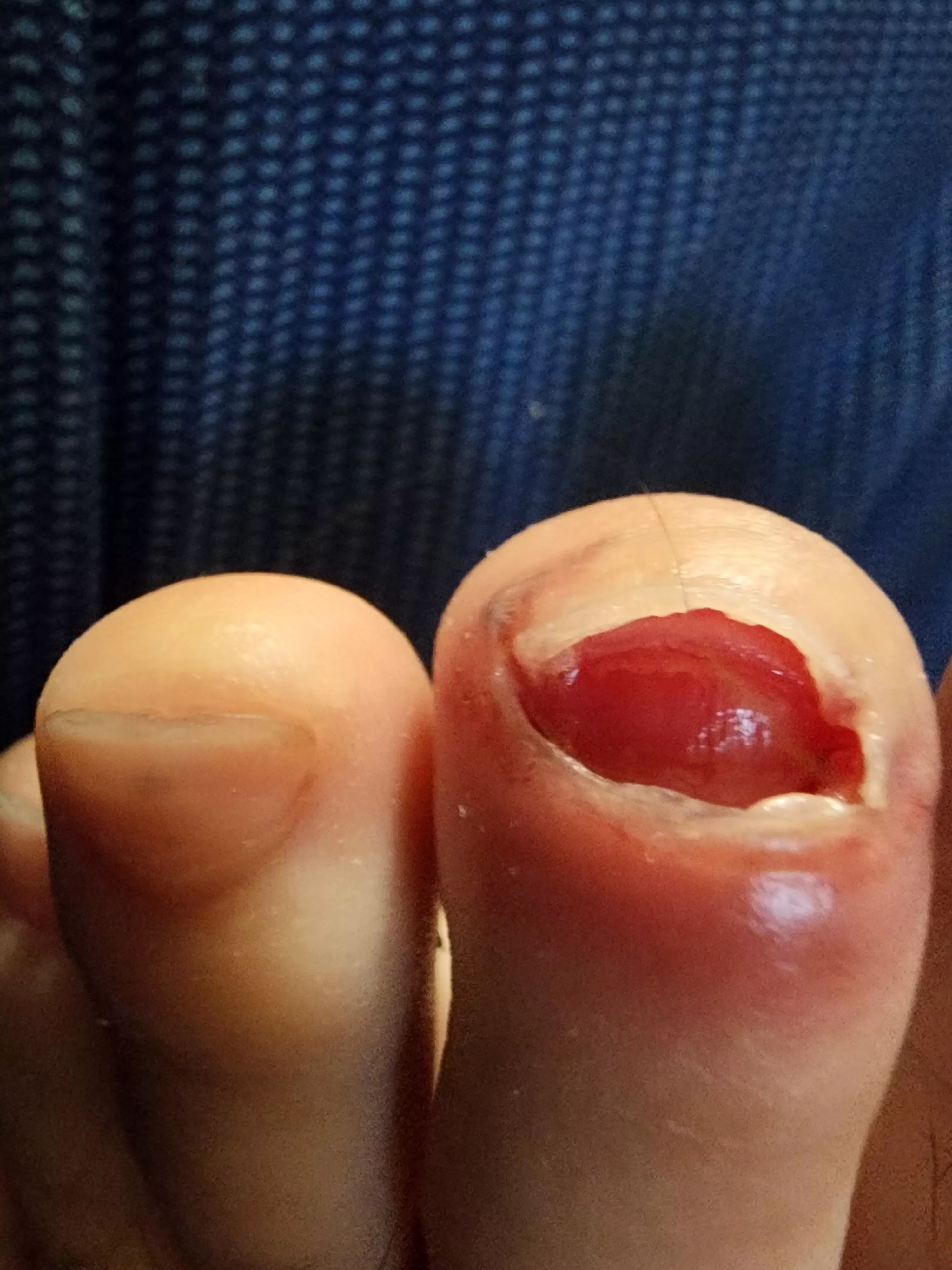 Lost my toenail after a 50k