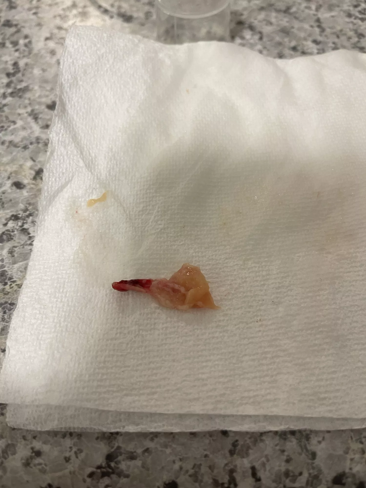 Fighting off a flu / cold, blew this nasal polyp out. I suspected I have had this for awhile but this surprised me. Will be seeing an ENT as soon as possible.