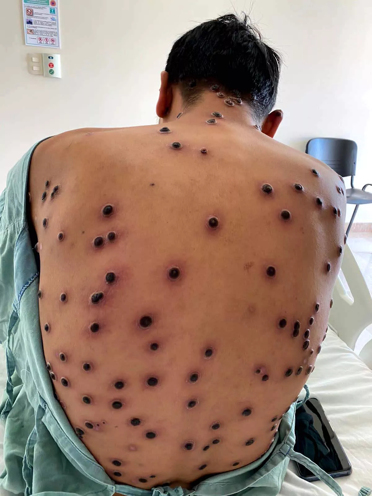 Found a photo of somebody with monkeypox - whole the back covered in forbidden black 3D pops. I thought you might appreciate it the same way I do.