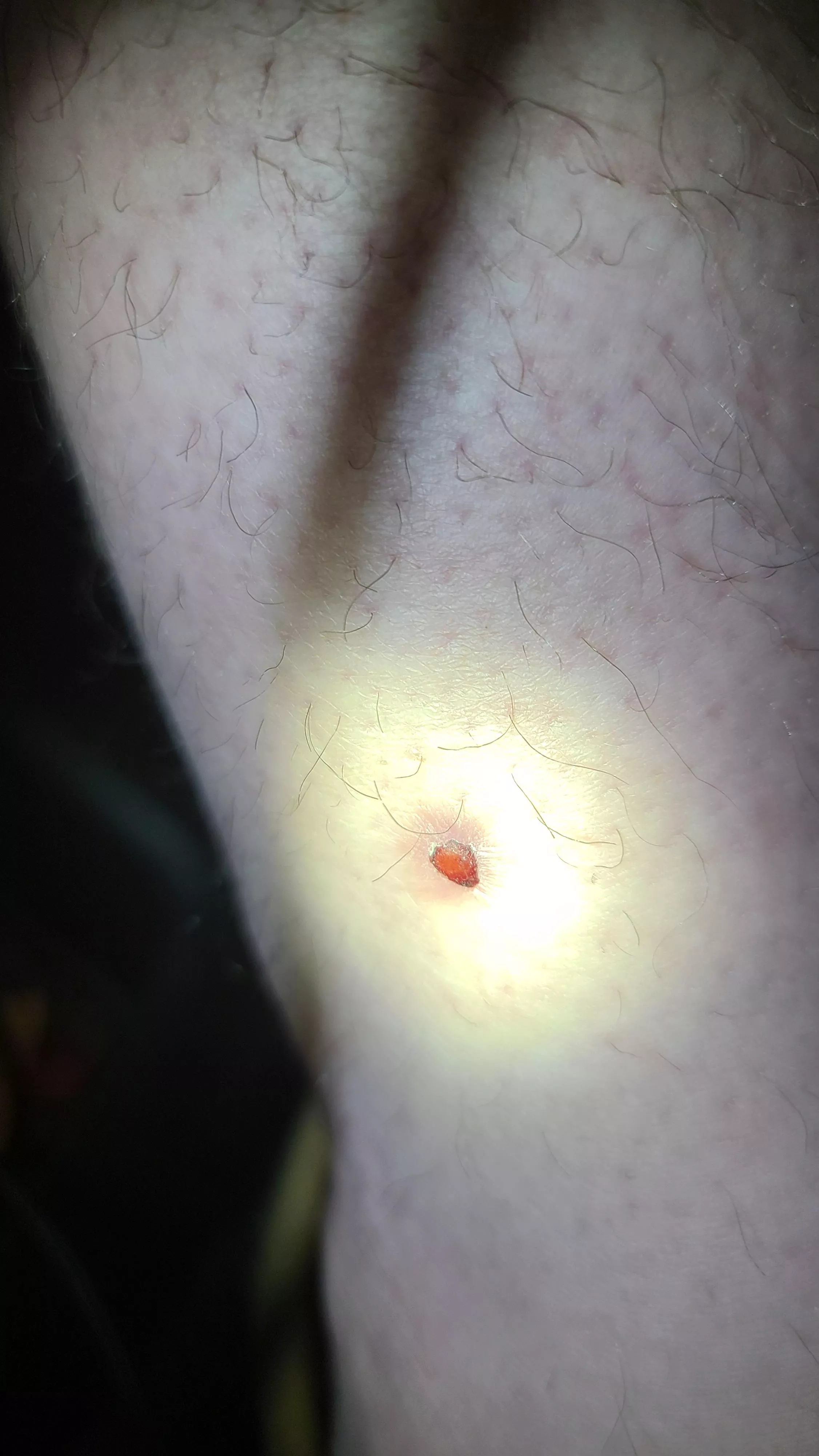 Random bump I've had for over 10 years, starting to scab again.