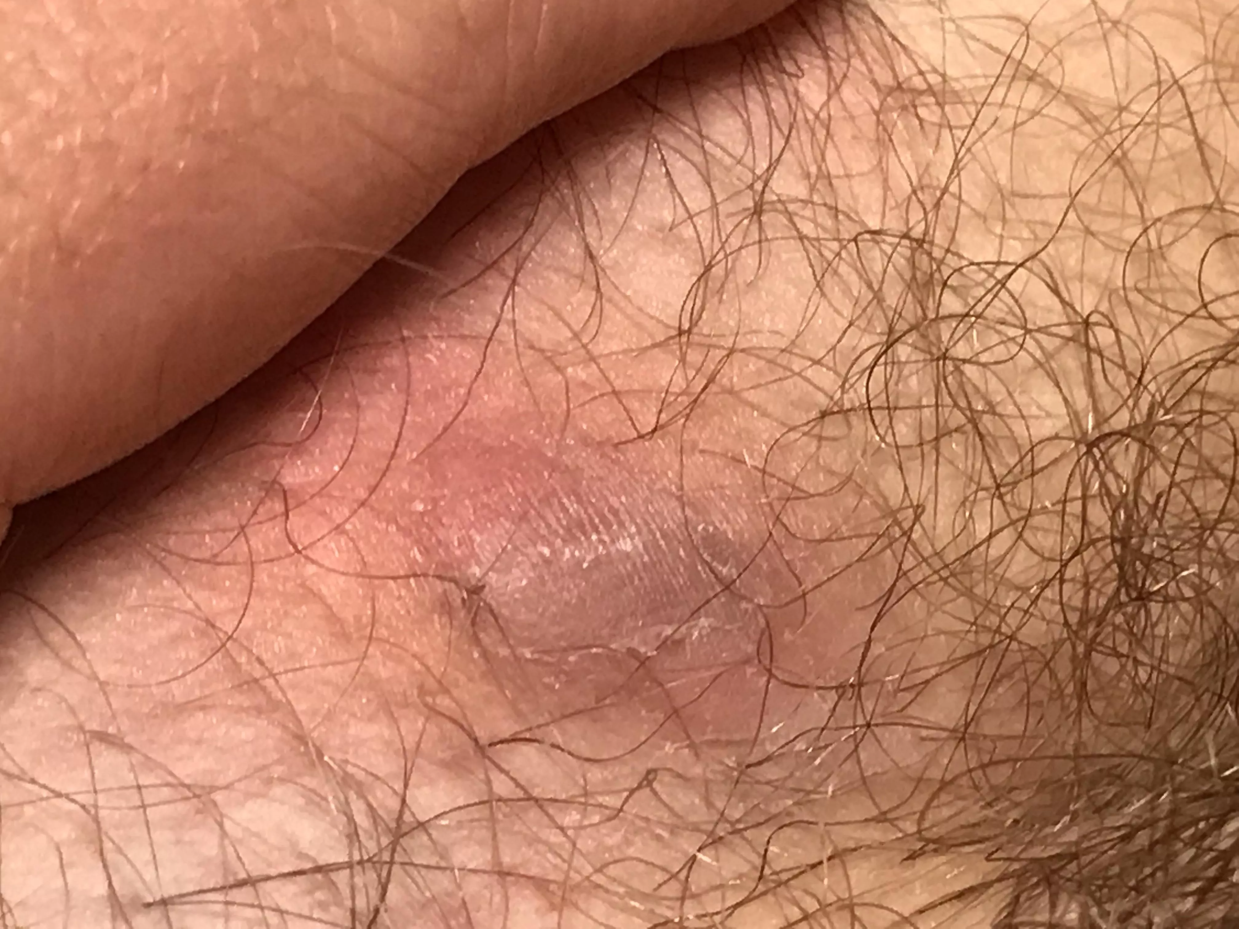 What is this on my inner thigh/groin area? Looks like a boil maybe? It’s definitely sore.